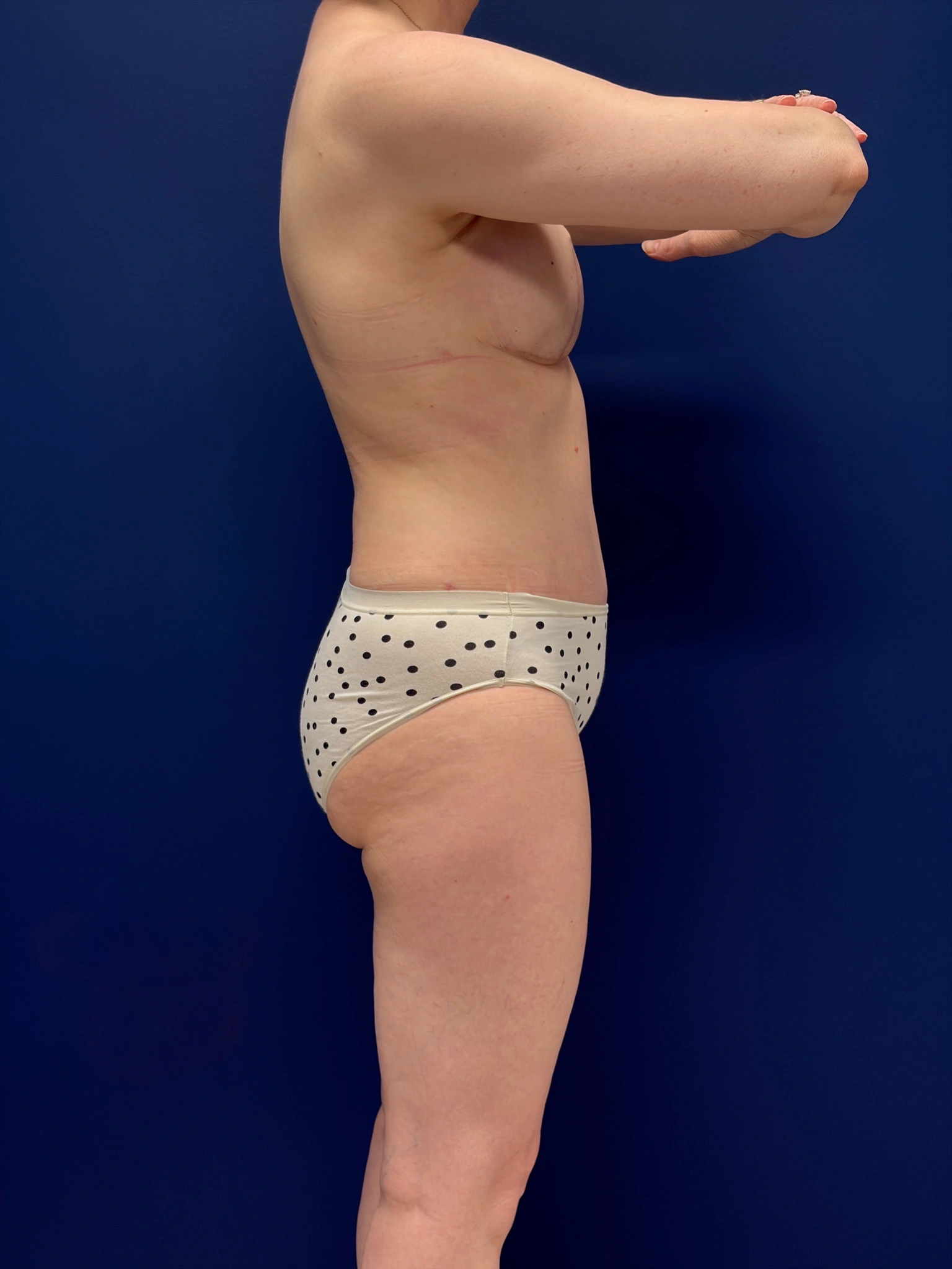 Abdominoplasty-Case--4180 | After Tummy Tuck 3