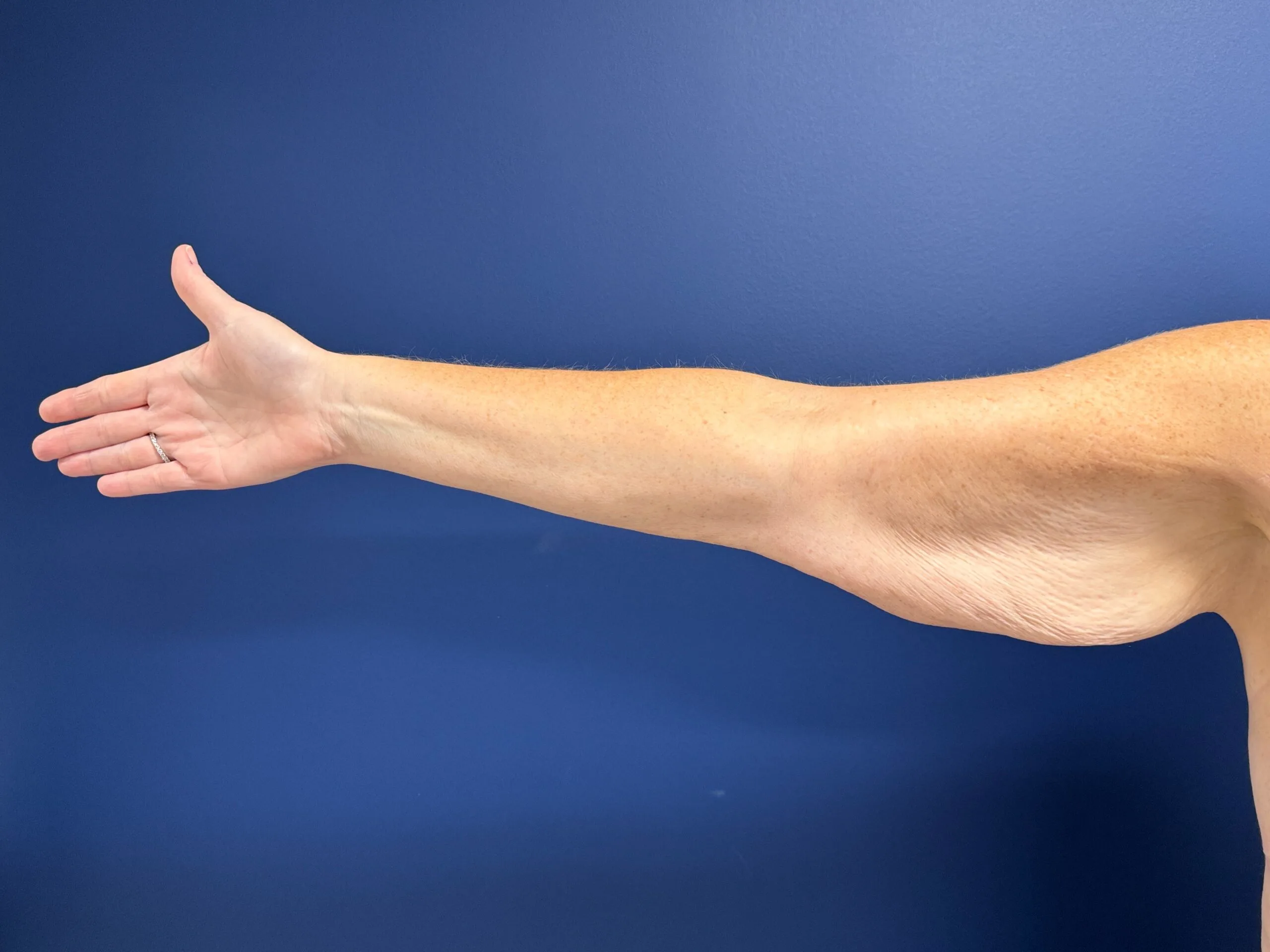 Brachioplasty-Case--3898 | Before Arm Lift 1