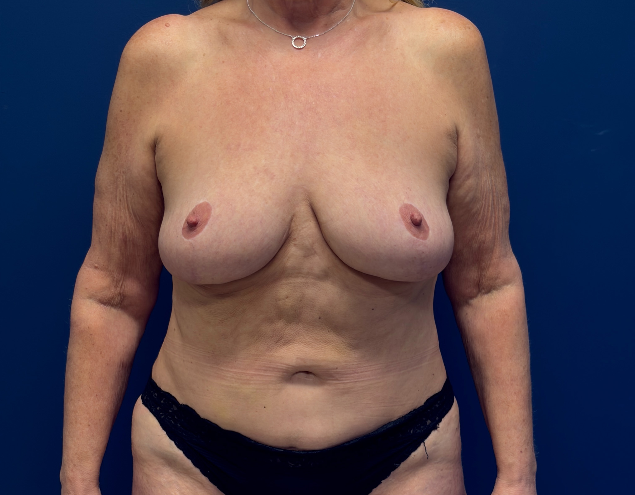 Preserv---Breast-Augmentation-Case--2946 | Before Preservé Breast Augmentation 1