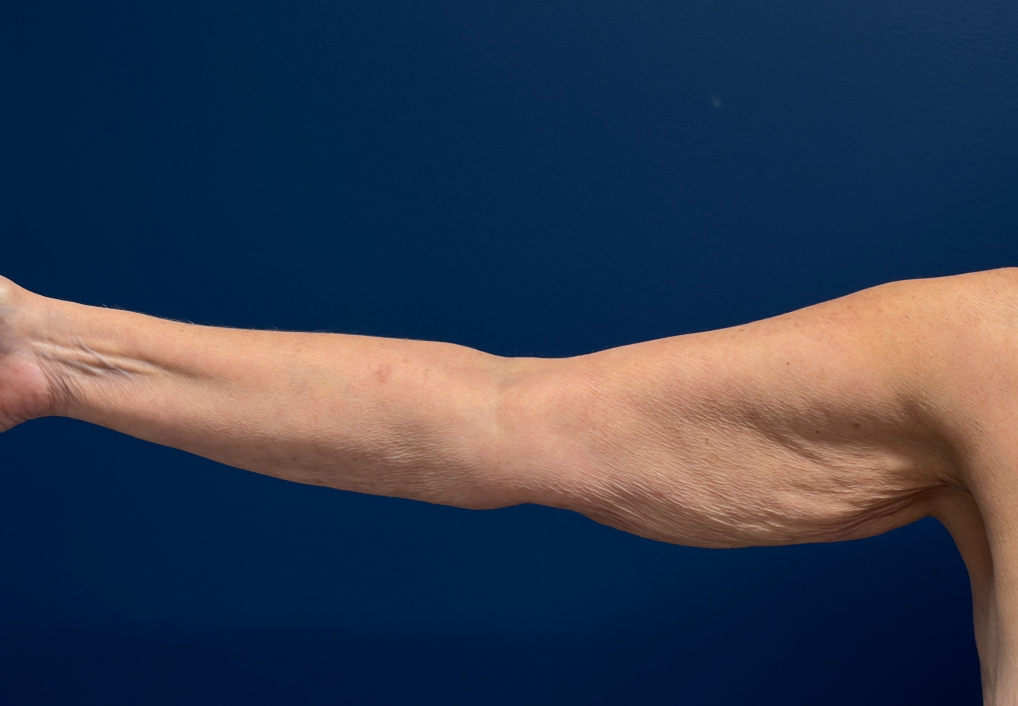 Brachioplasty-Case--4934 | Before Body 1