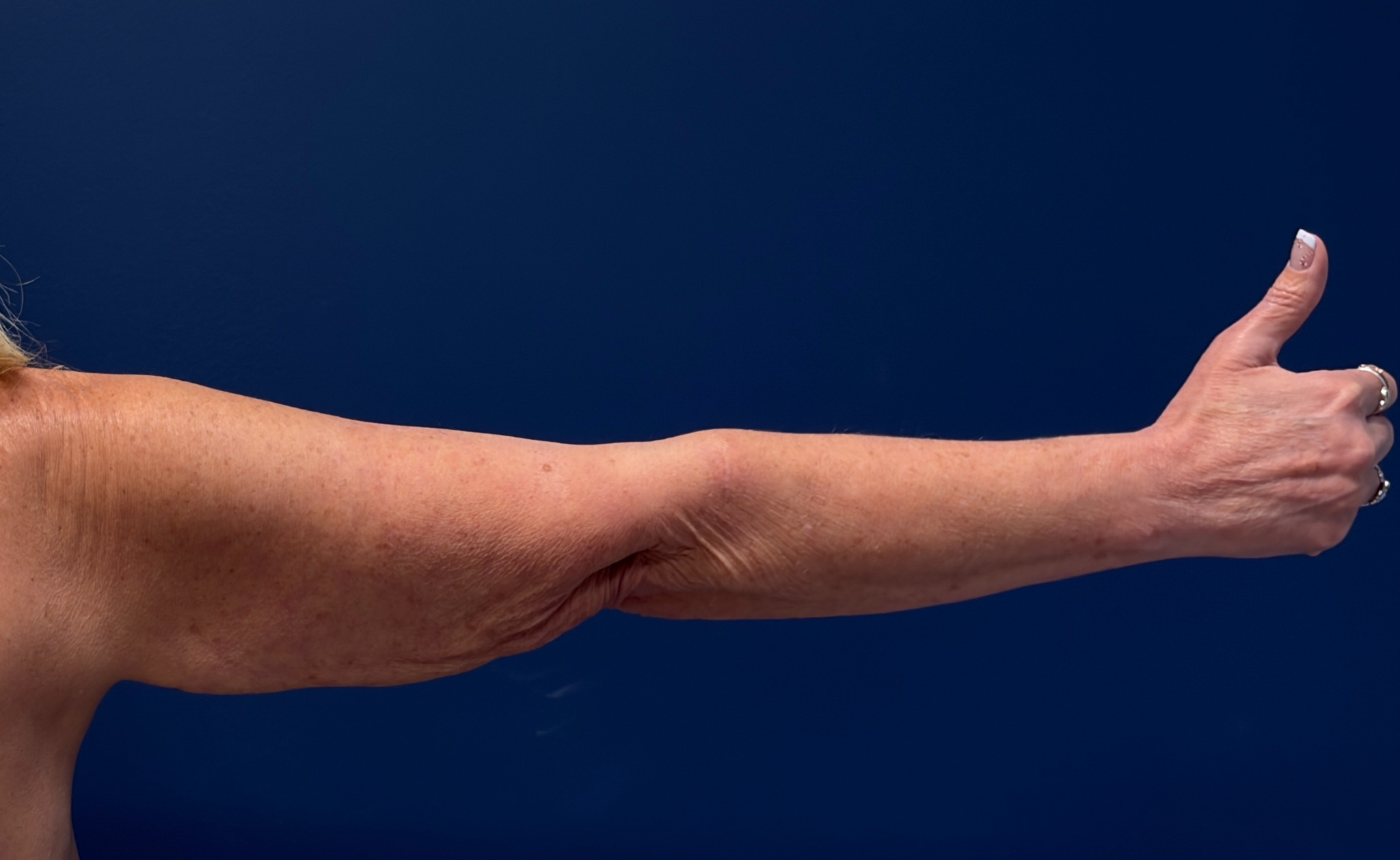 Brachioplasty-Case--4934 | Before Arm Lift 4