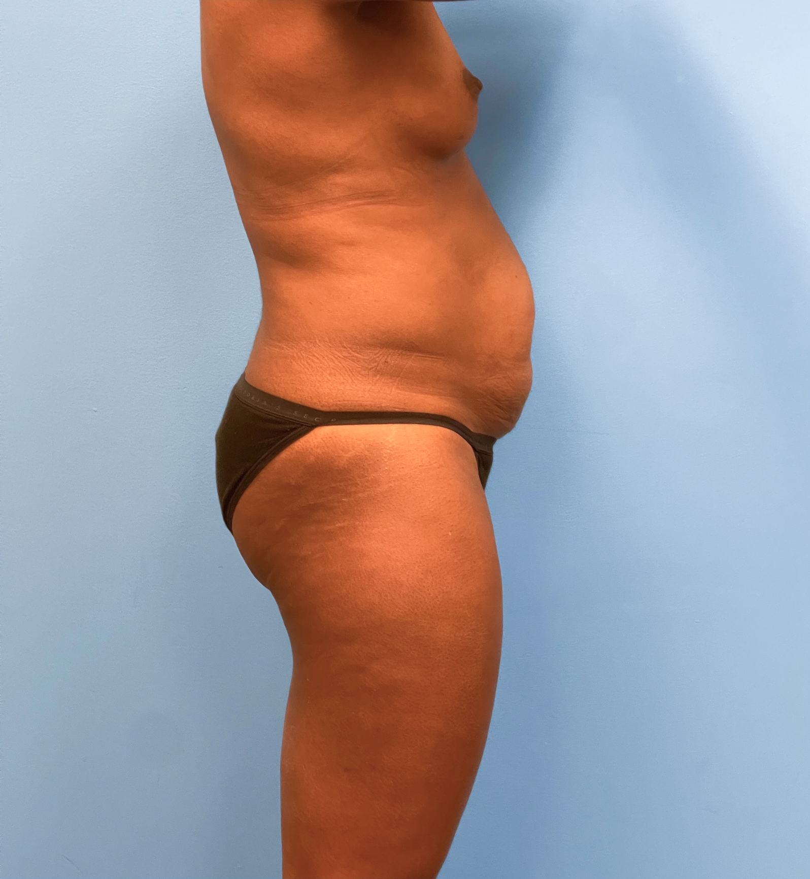 Abdominoplasty-Case--28134 | Before Body 2