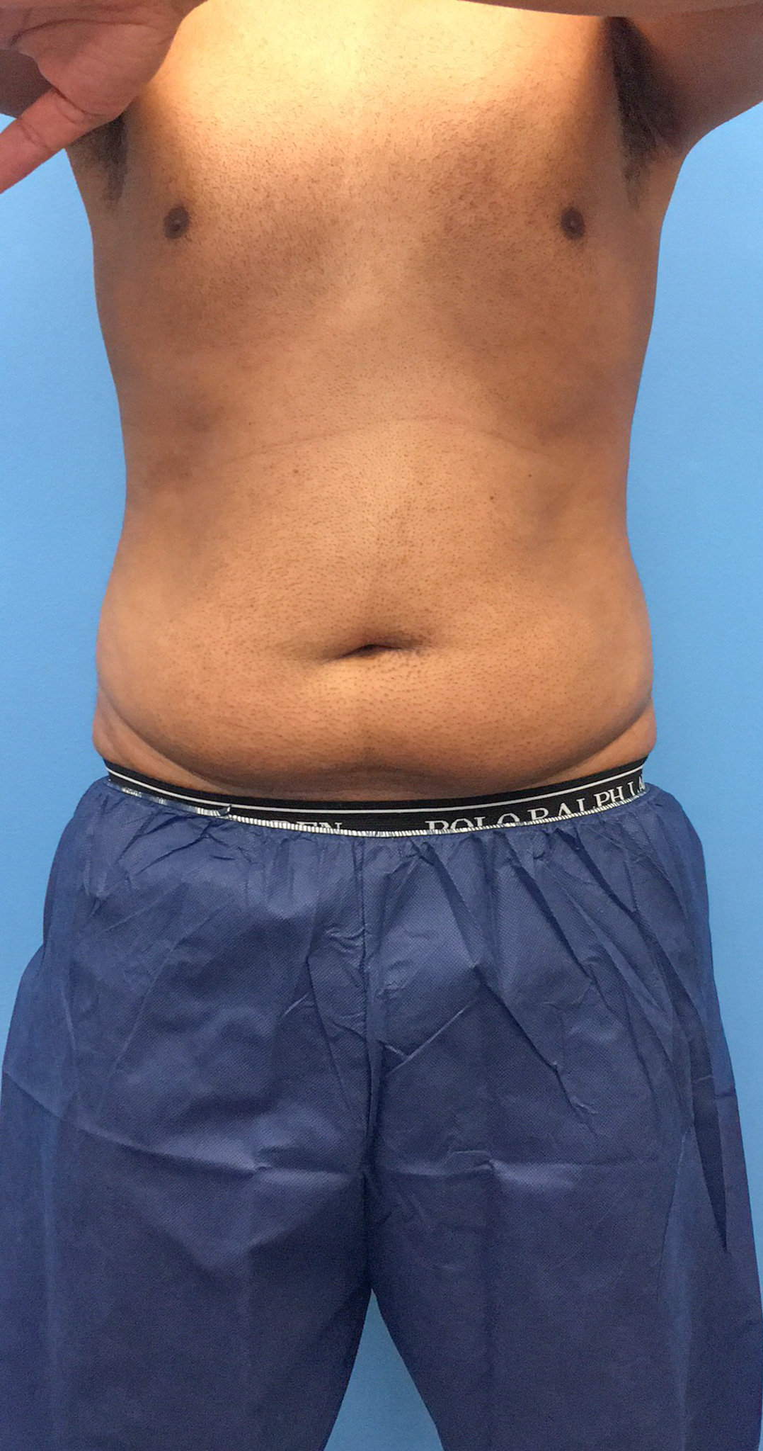 Lipo-360-Case--4979 | Before Body 1