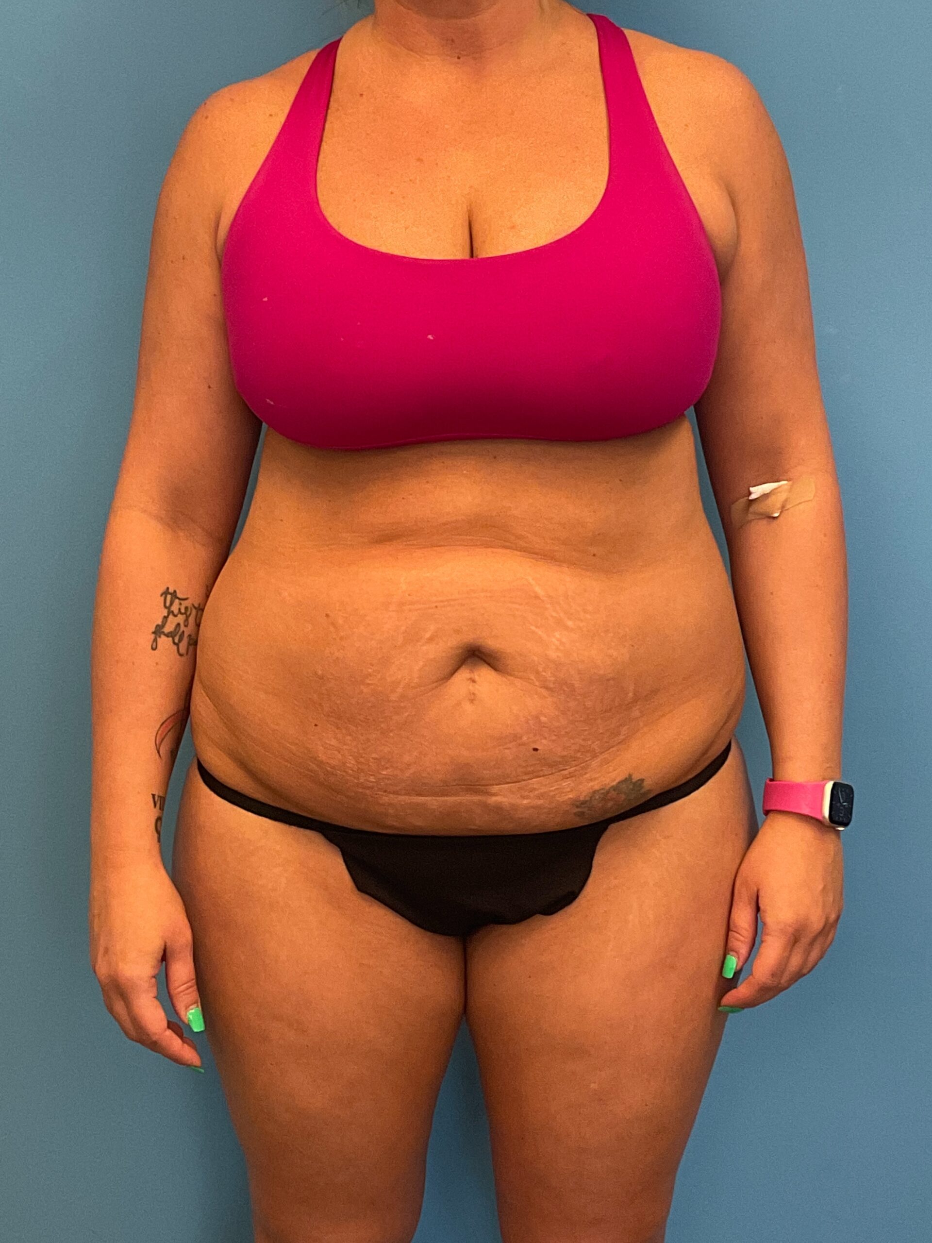 Abdominoplasty-Case--3117 | Before Body 1