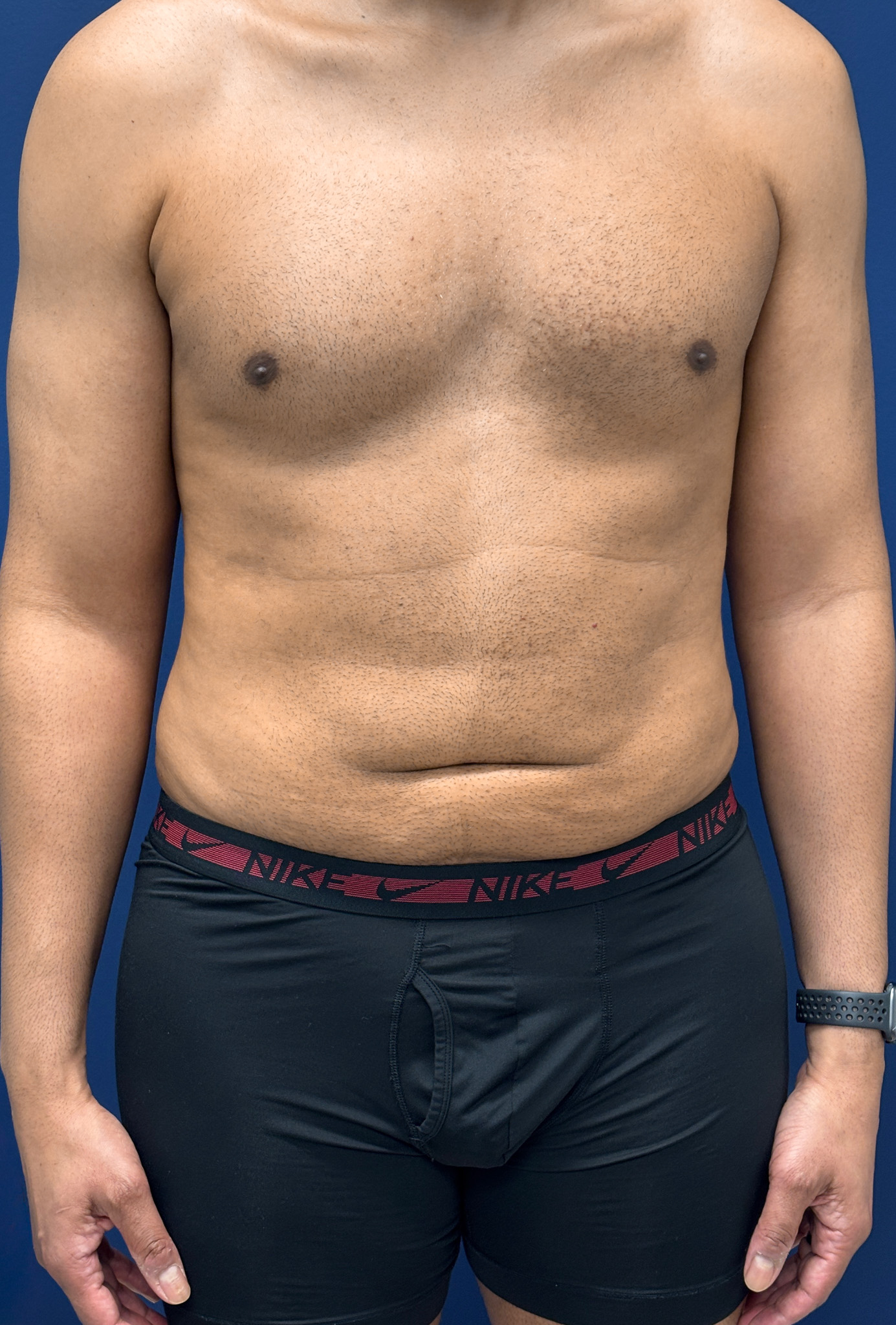 Lipo-360-Case--4979 | After Body 1