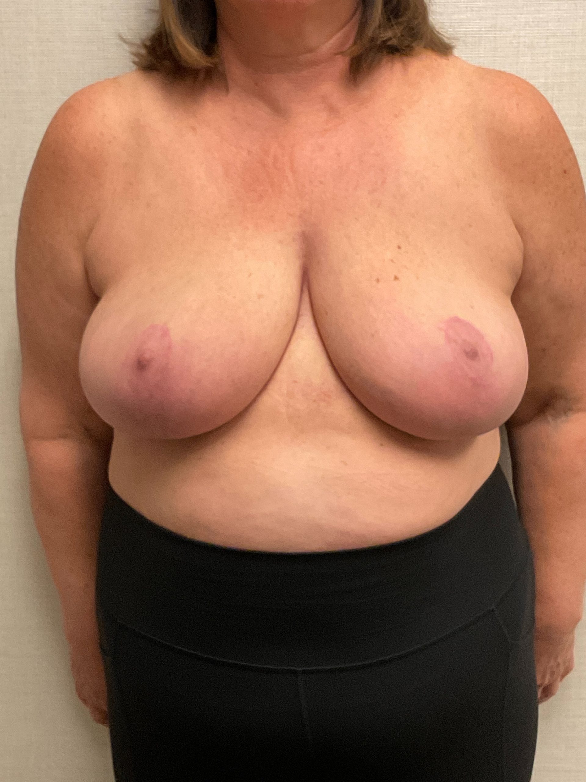 Breast-Reduction-Case--26425 | After Breast Reduction 1