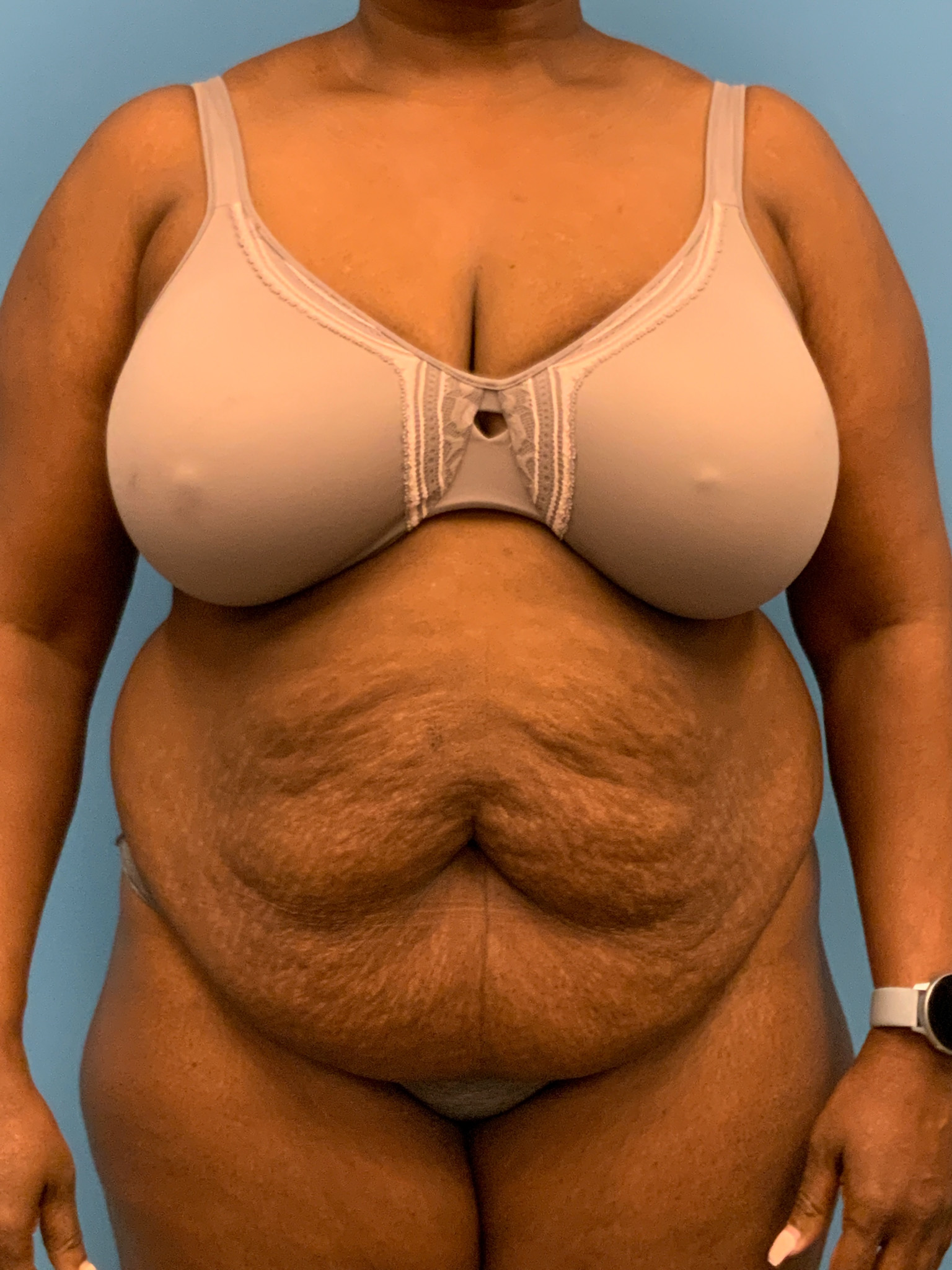 Abdominoplasty-Case--5907 | Before Body 1