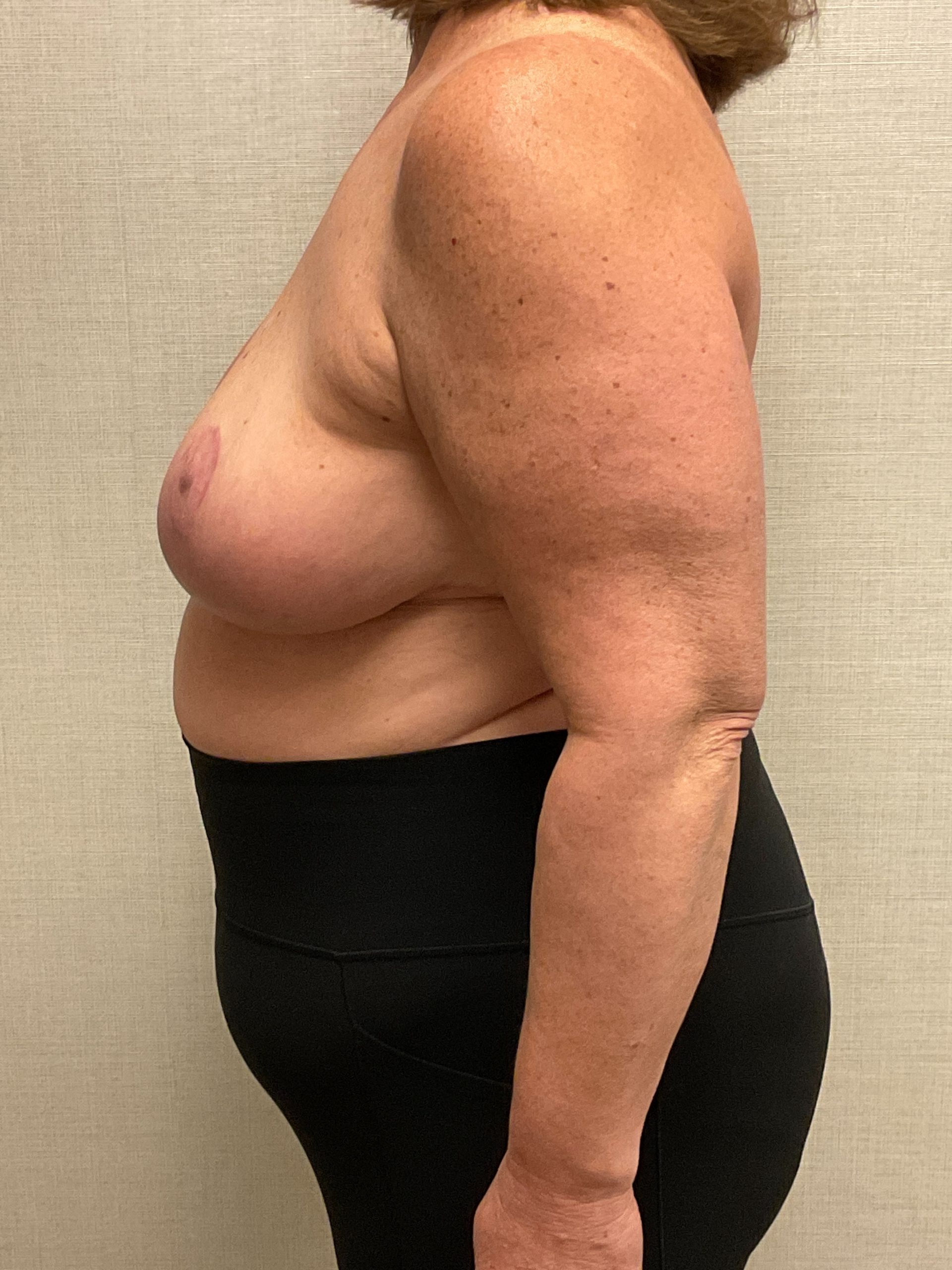 Breast-Reduction-Case--26425 | After Breast Reduction 2