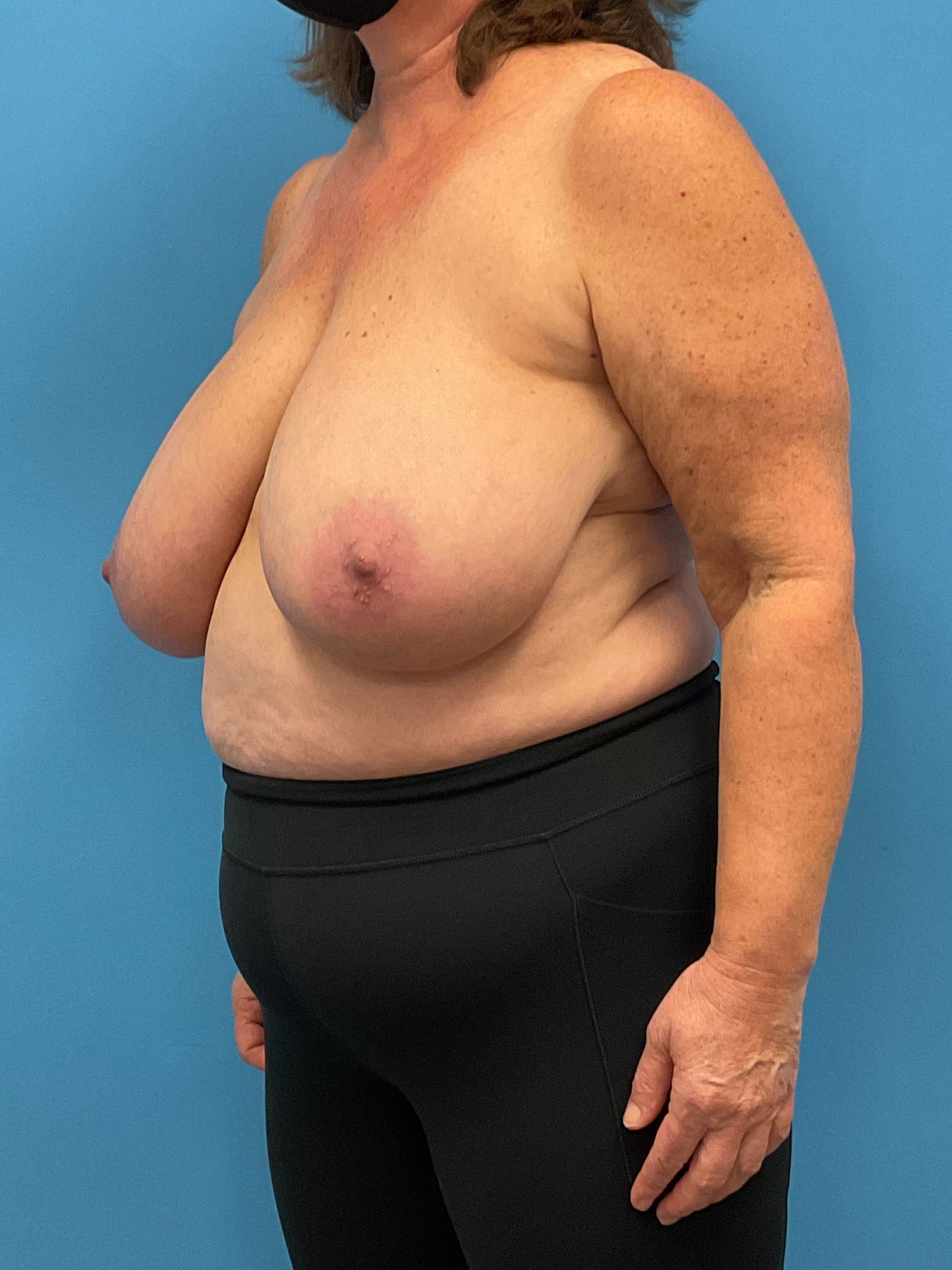 Breast-Reduction-Case--26425 | Before Breast Reduction 4