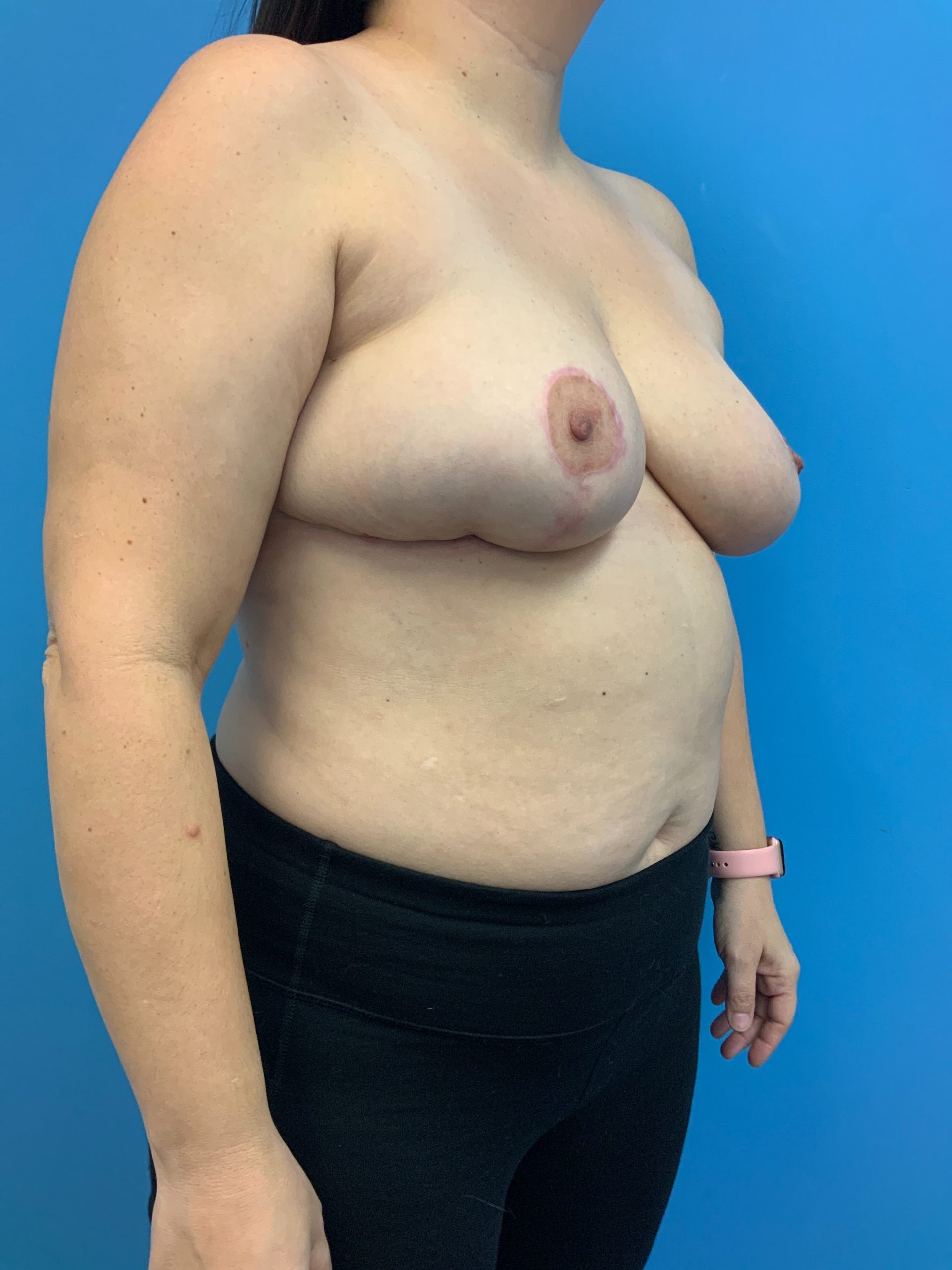Breast-Reconstruction-Case--6507 | After Breast Reconstruction 4