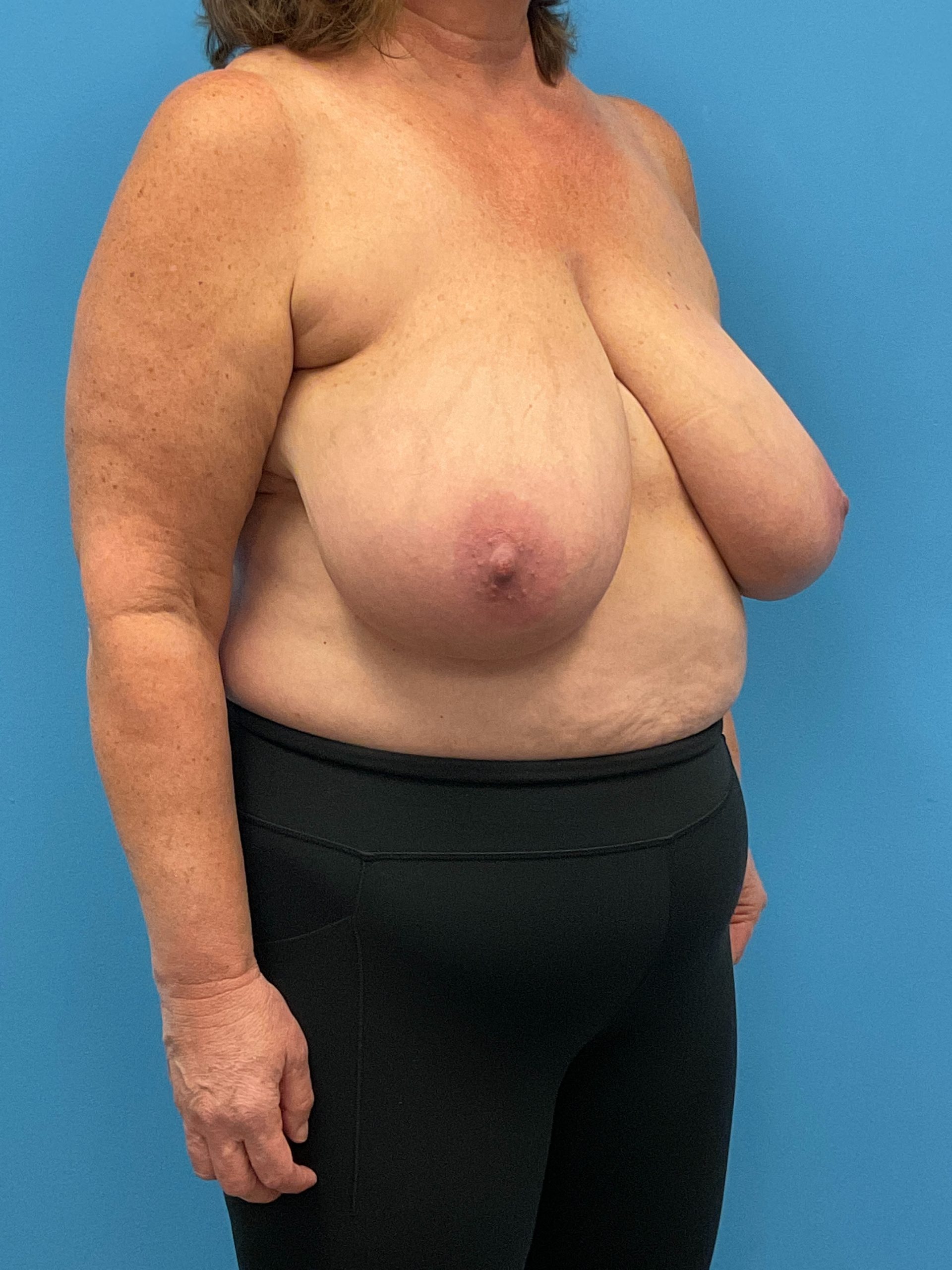 Breast-Reduction-Case--26425 | Before Breast Reduction 5