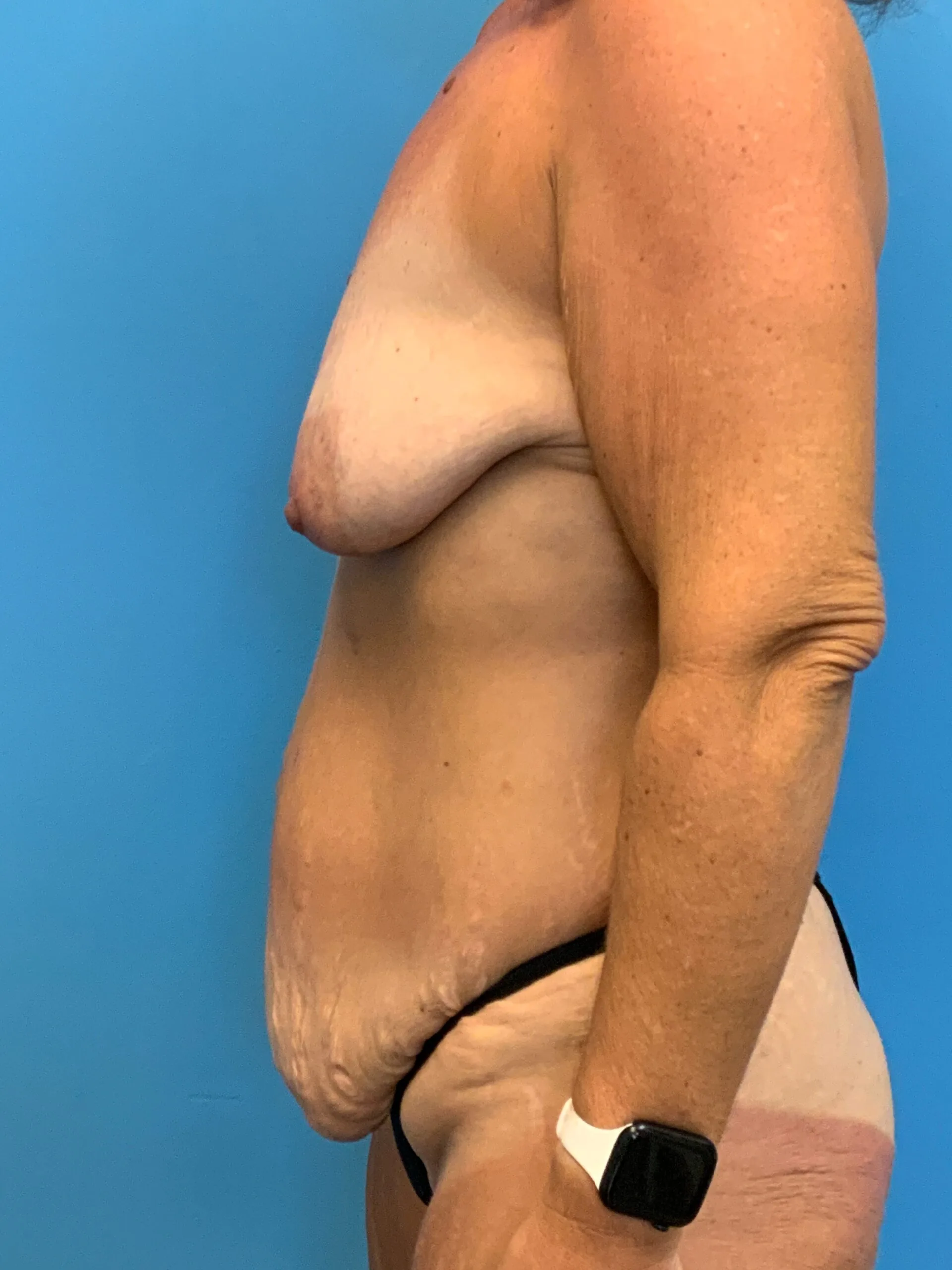 Abdominoplasty-Case--7009 | Before Tummy Tuck 3