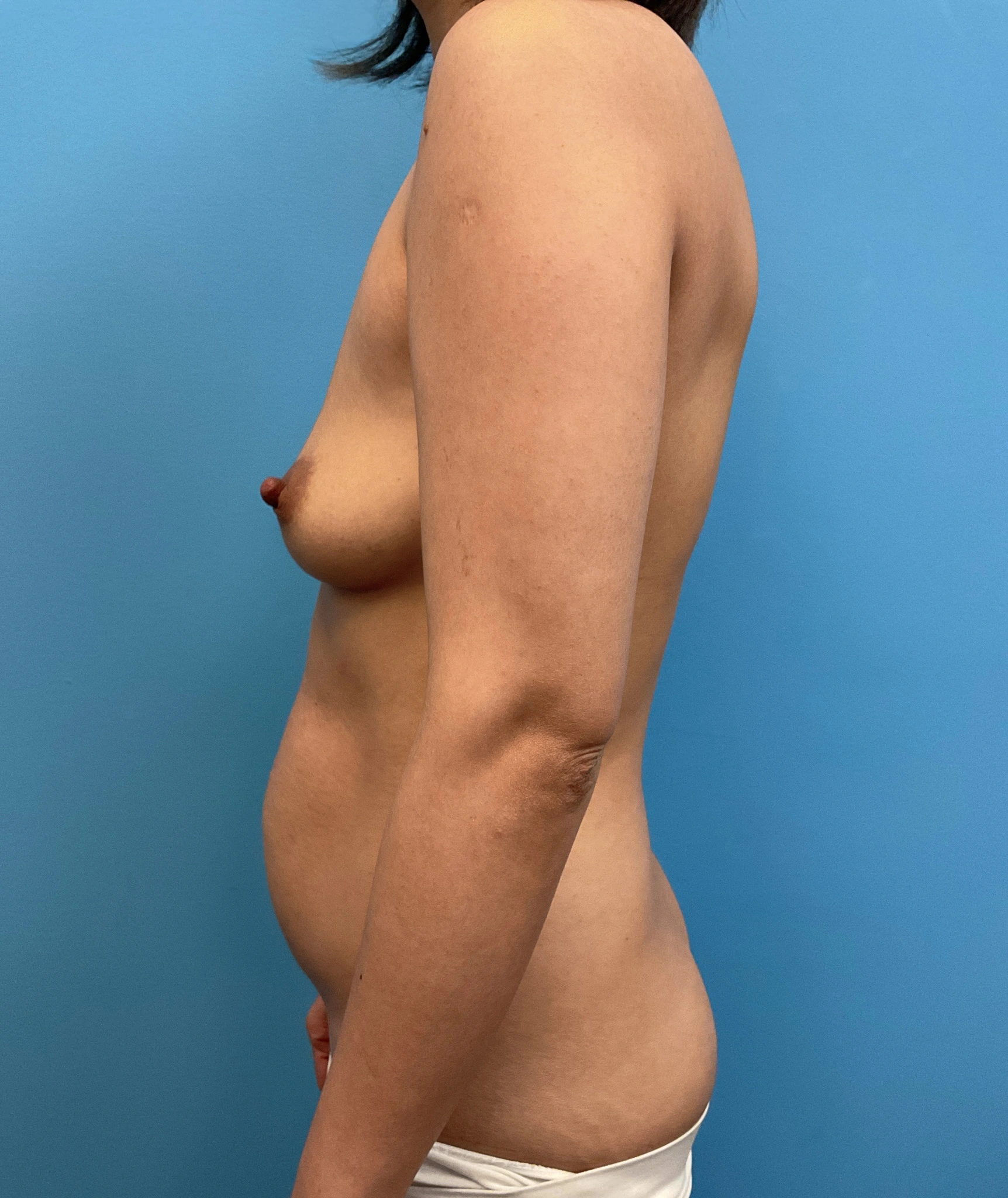 Breast-Augmentation-Case--4098 | Before Breast Augmentation 3