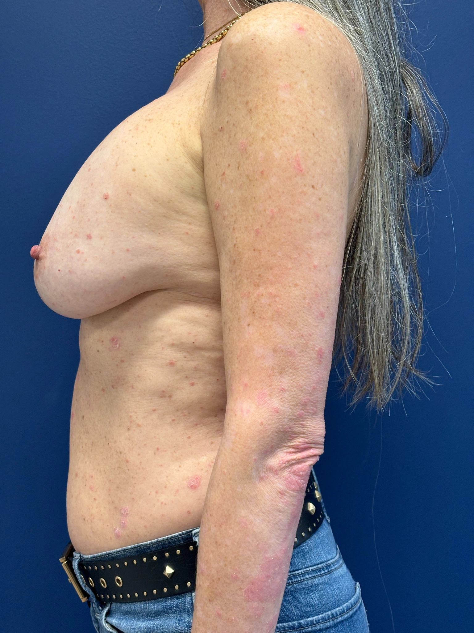 Breast-Reconstruction-Case--8978 | Before Breast Reconstruction 2
