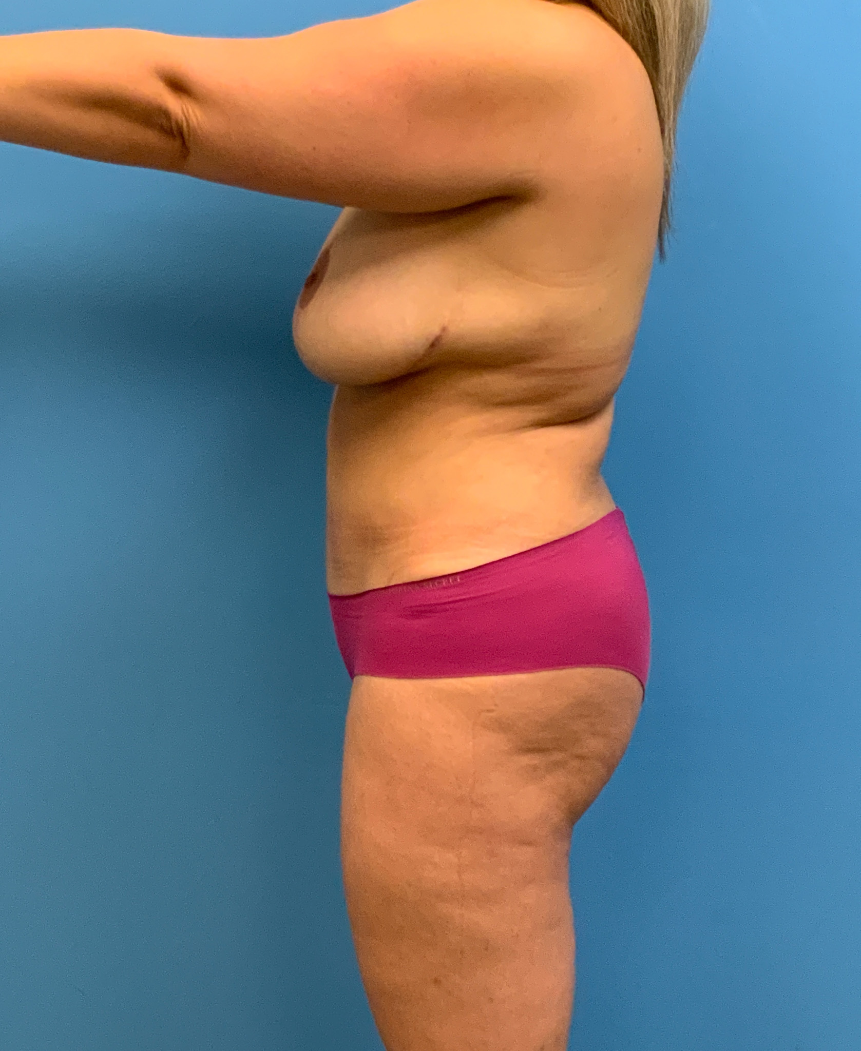 Abdominoplasty-Case--3073 | After Body 2