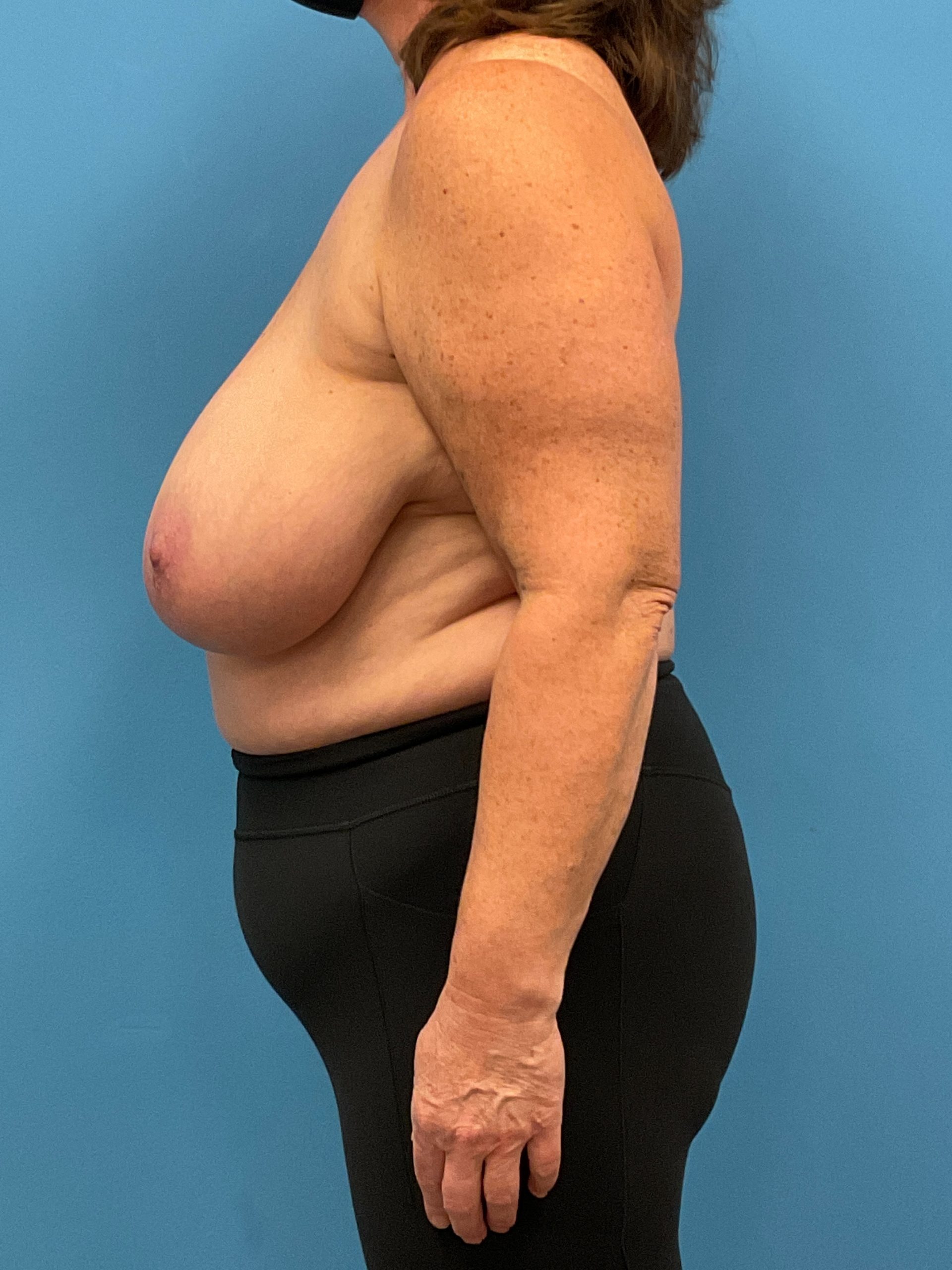Breast-Reduction-Case--26425 | Before Breast Reduction 2