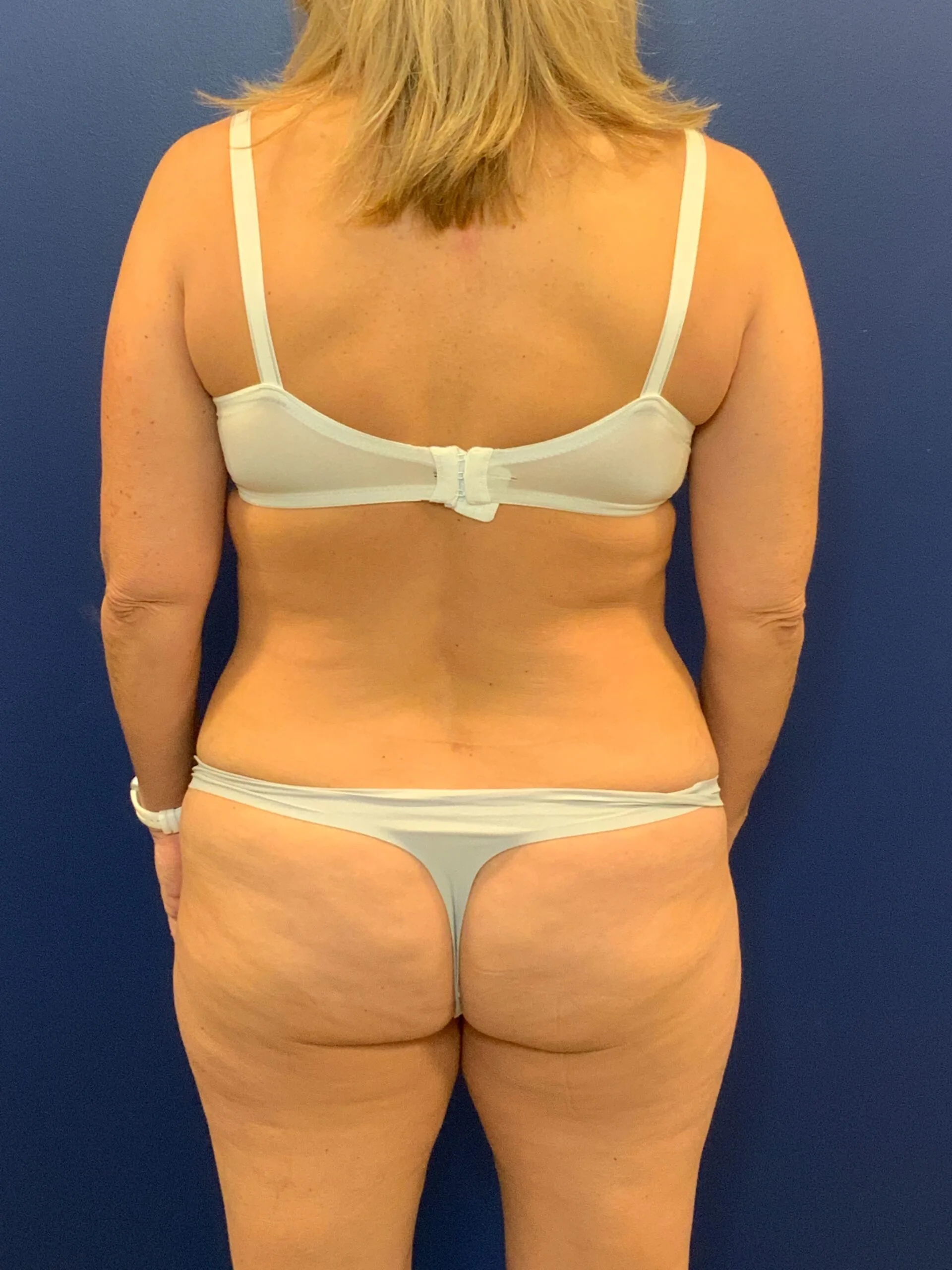 Abdominoplasty-Case--7924 | Before Tummy Tuck 4