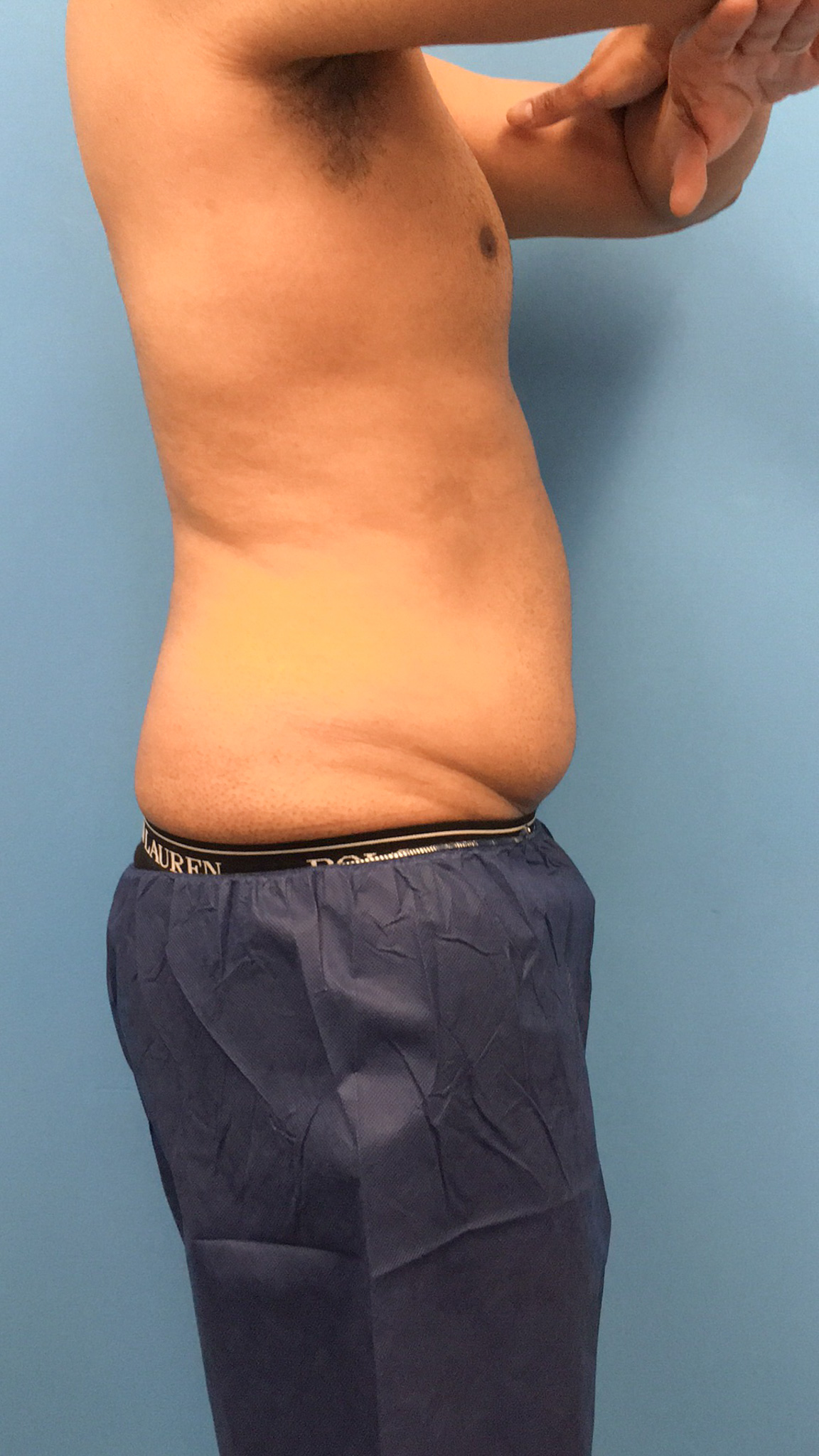 Lipo-360-Case--4979 | Before Body 2