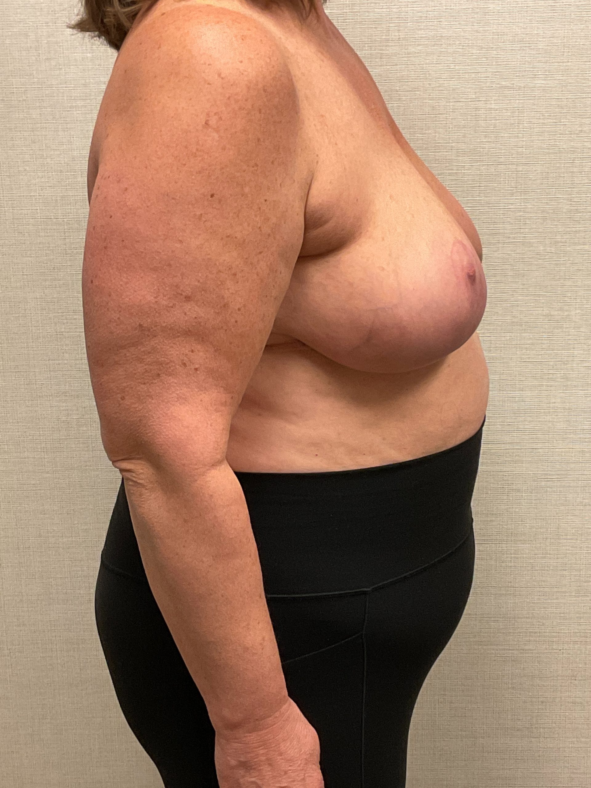 Breast-Reduction-Case--26425 | After Breast Reduction 3