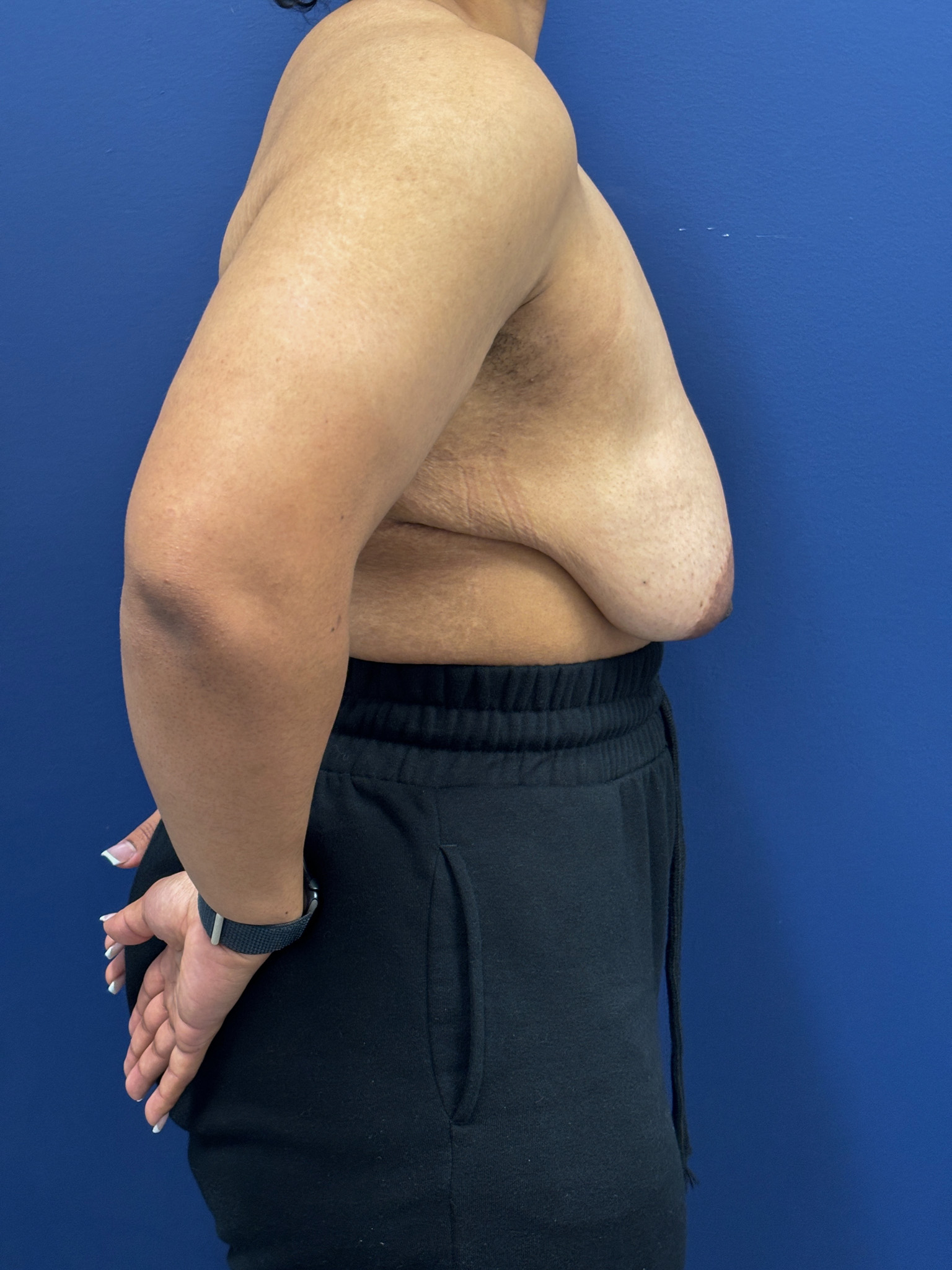 Breast-Reduction-Case--7345 | Before Breast Reduction 2