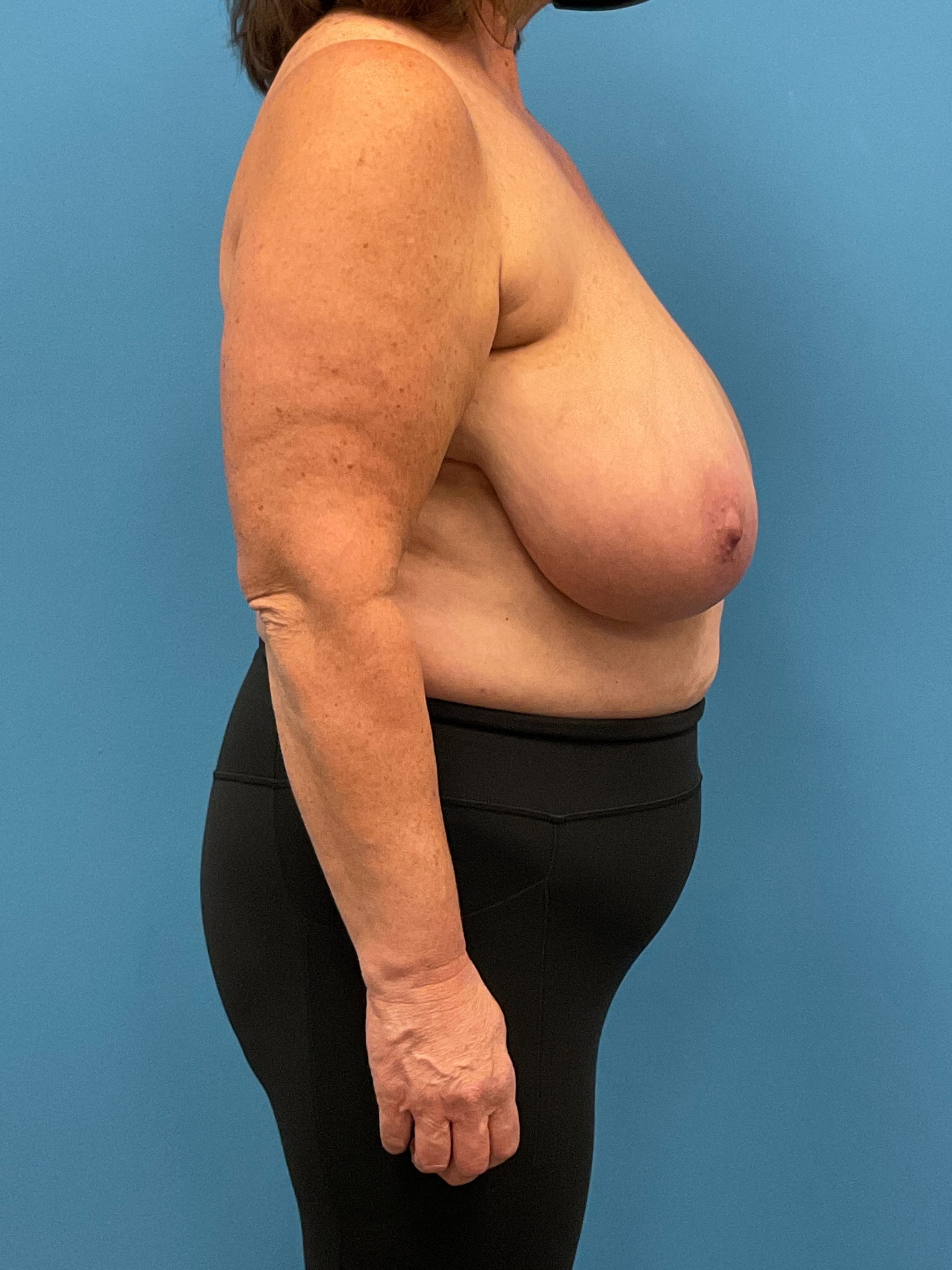 Breast-Reduction-Case--26425 | Before Breast Reduction 3