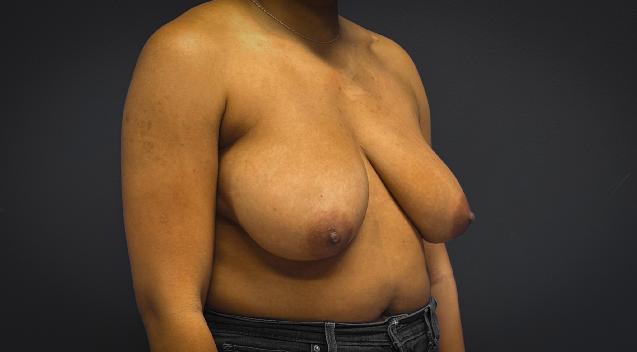 Breast-Reduction-Case--7089 | Before Breast Reduction 4