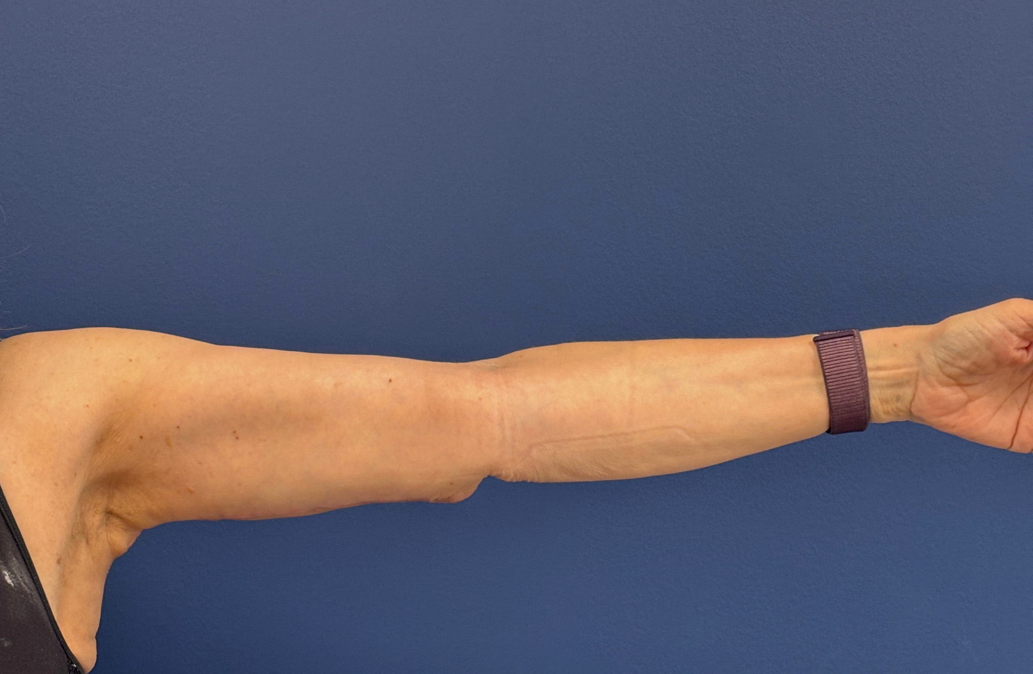Brachioplasty-Case--3625 | After Arm Lift 5