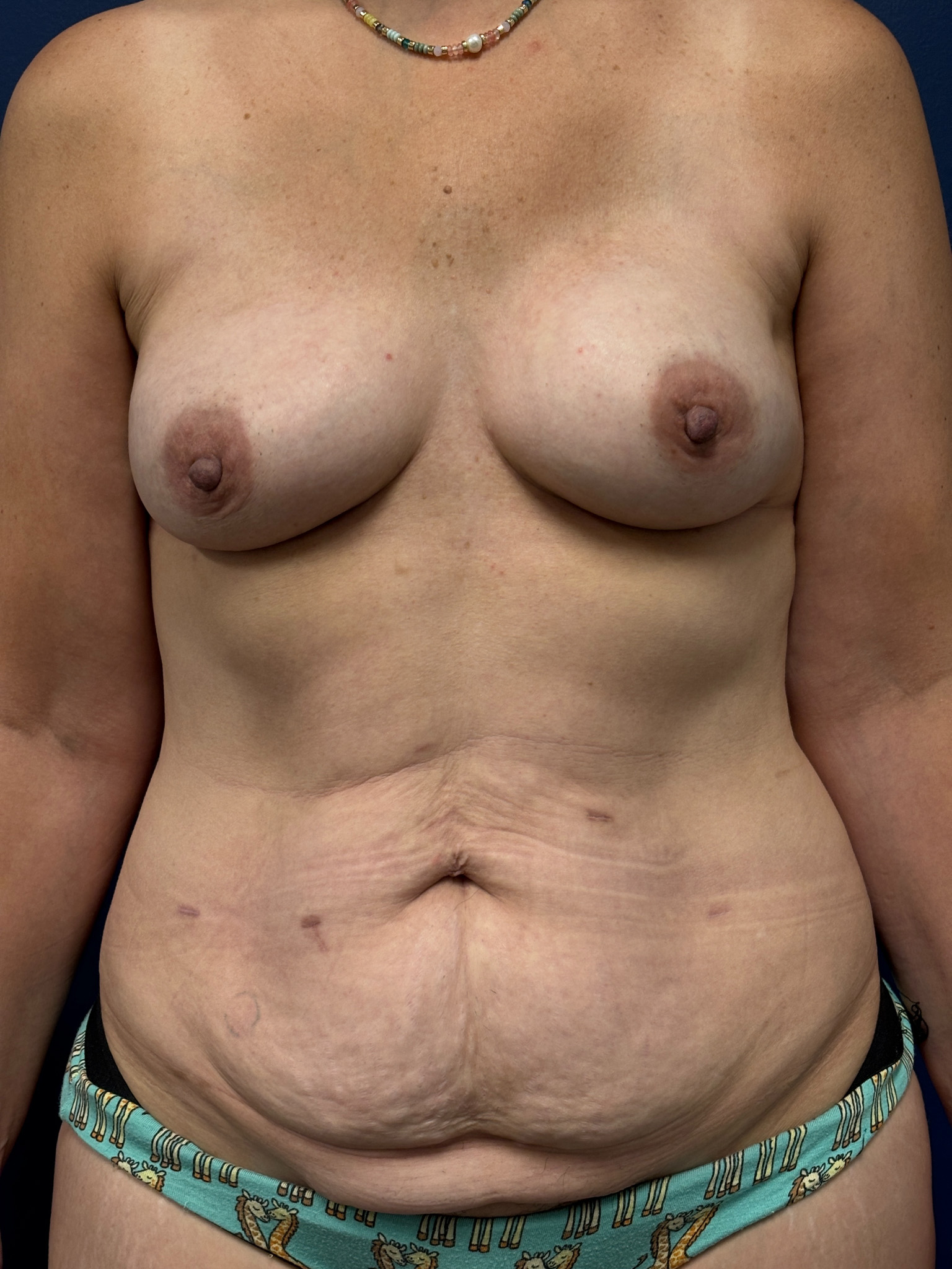 Abdominoplasty-Case--4660 | Before Tummy Tuck 1