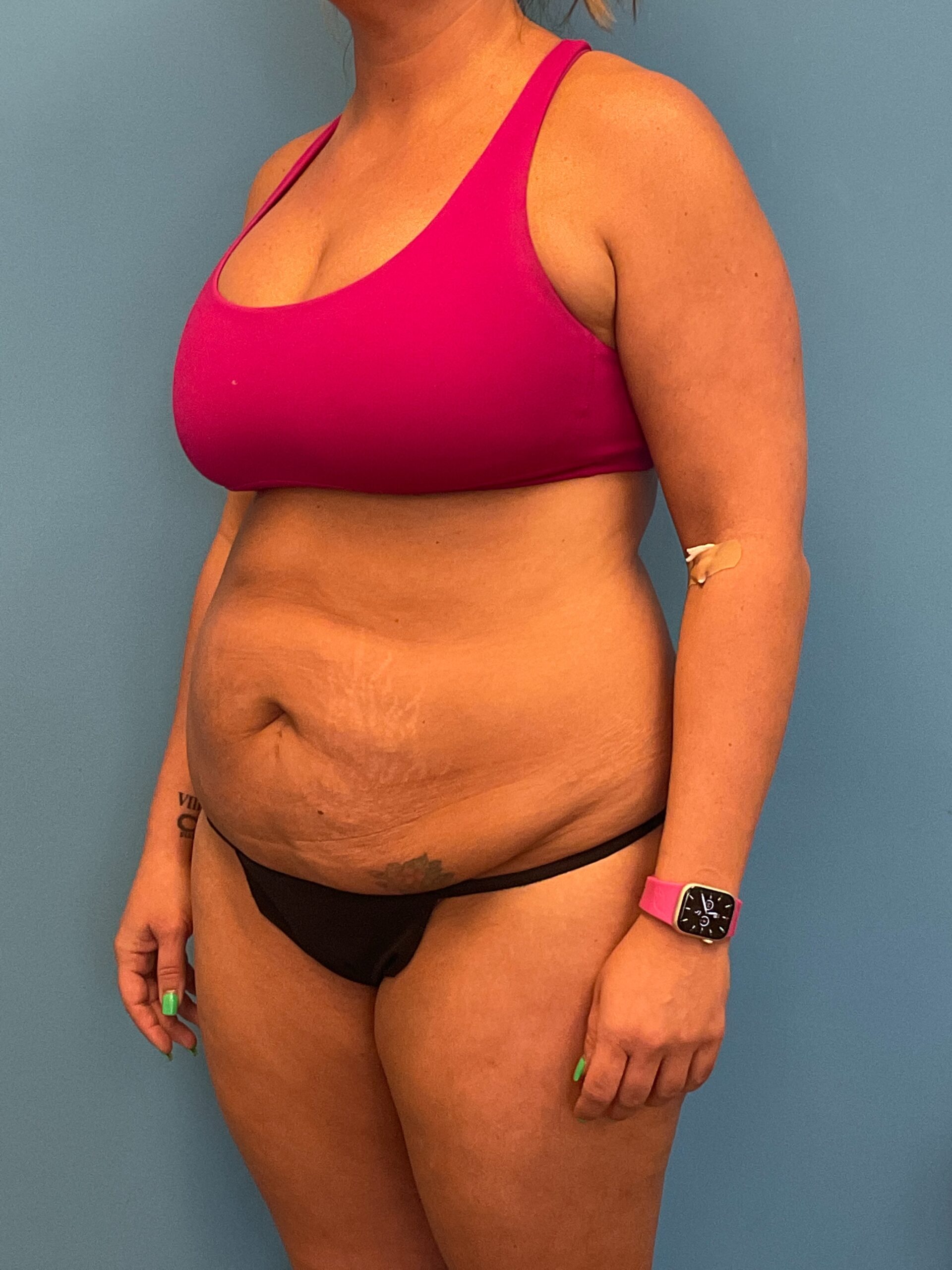 Abdominoplasty-Case--3117 | Before Tummy Tuck 4
