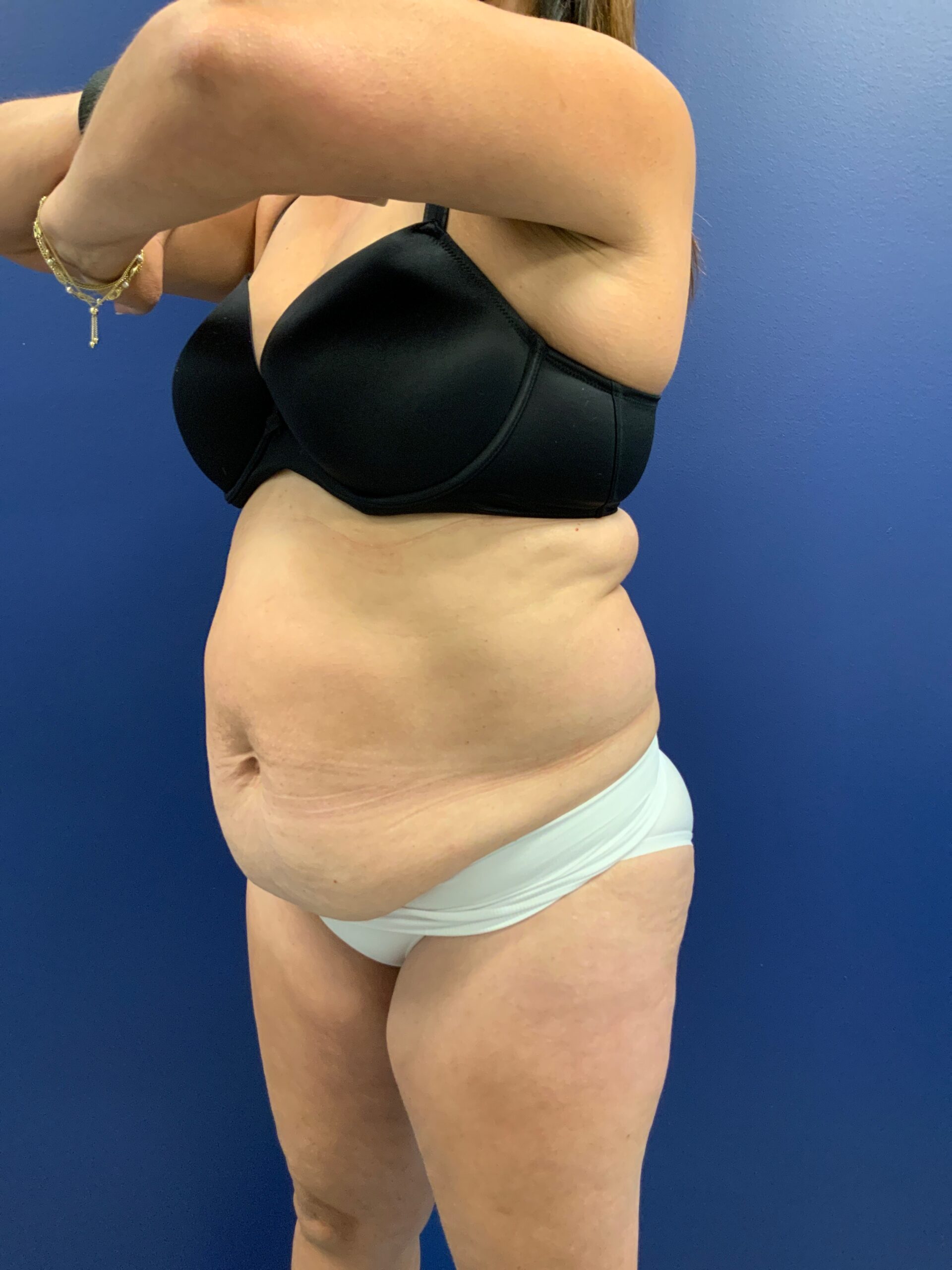 Abdominoplasty-Case--21804 | Before Tummy Tuck 4