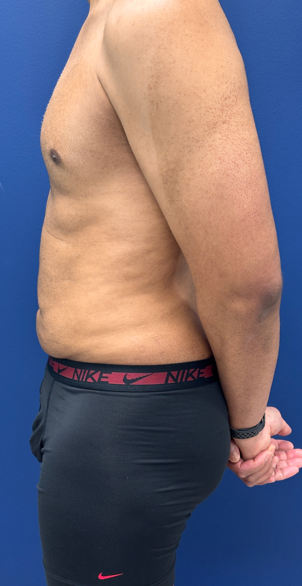 Lipo-360-Case--4979 | After Liposuction 3