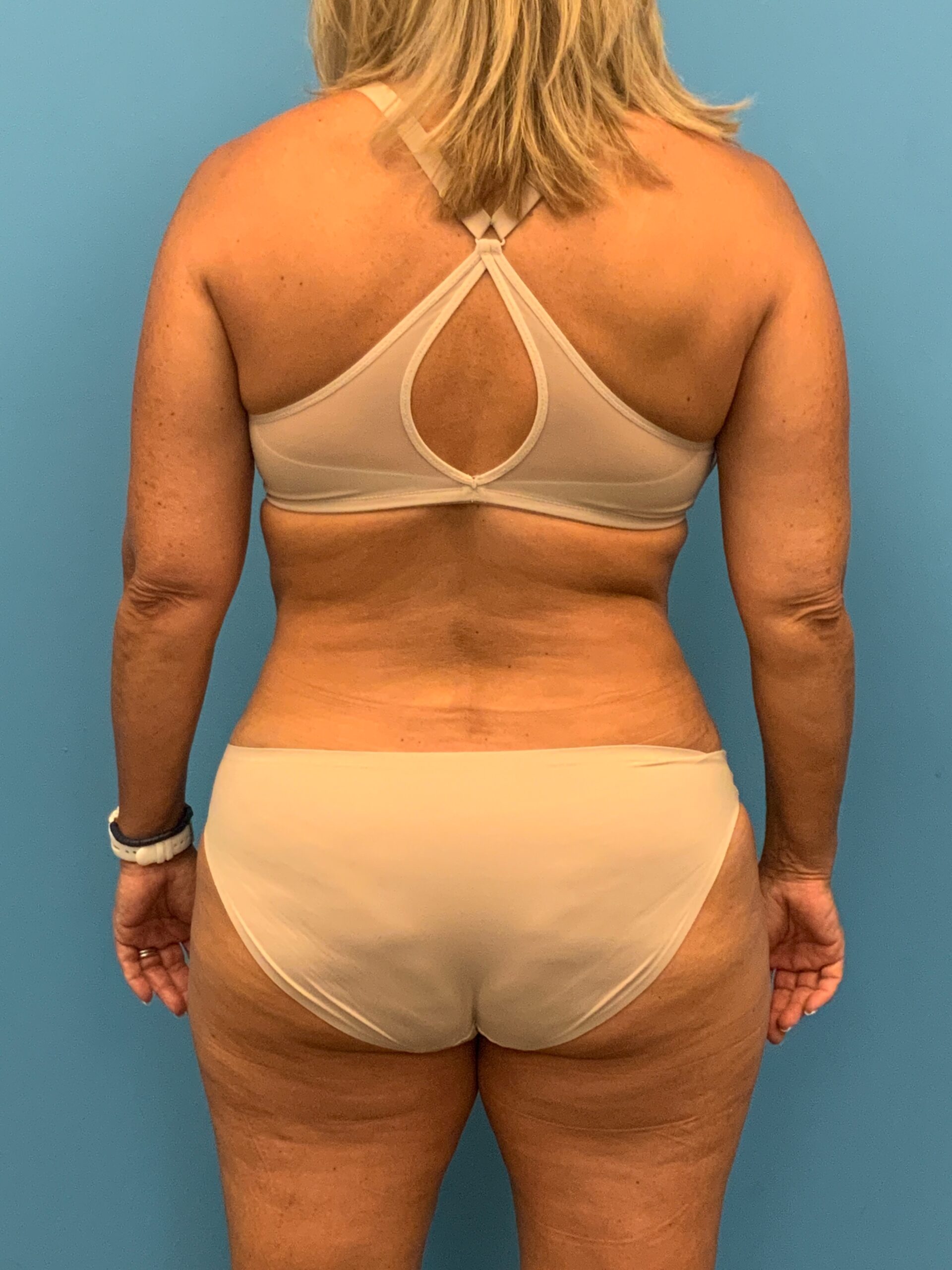 Abdominoplasty-Case--7924 | After Tummy Tuck 4