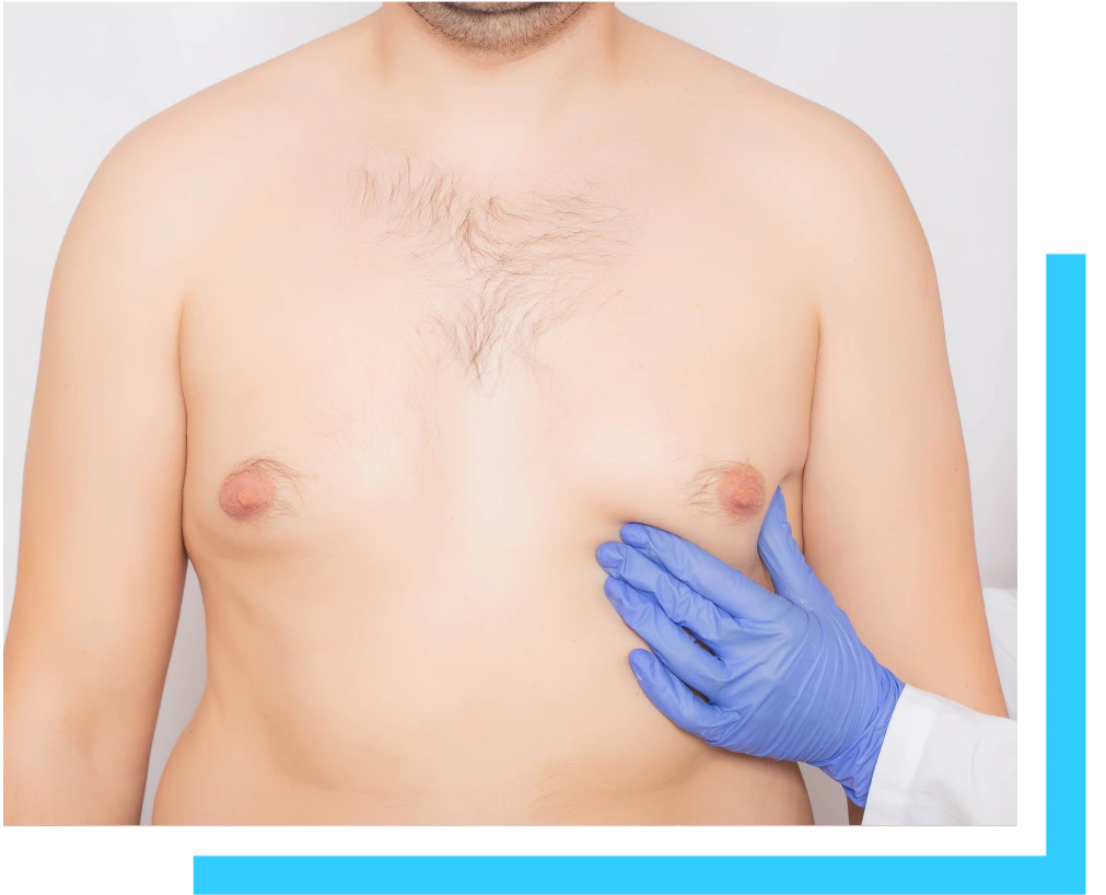 What Is Gynecomastia? Banner