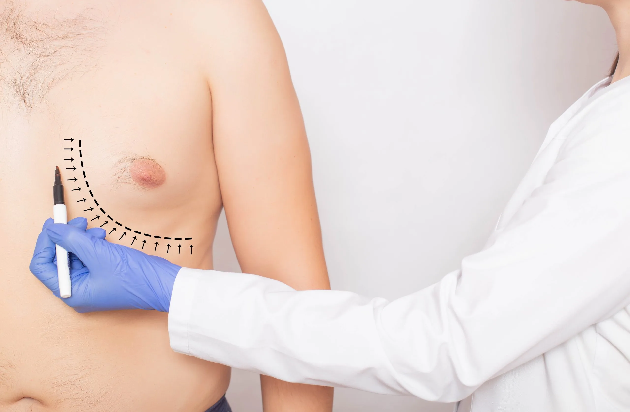 Surgeon in blue gloves marking breast with surgical pen before cosmetic procedure