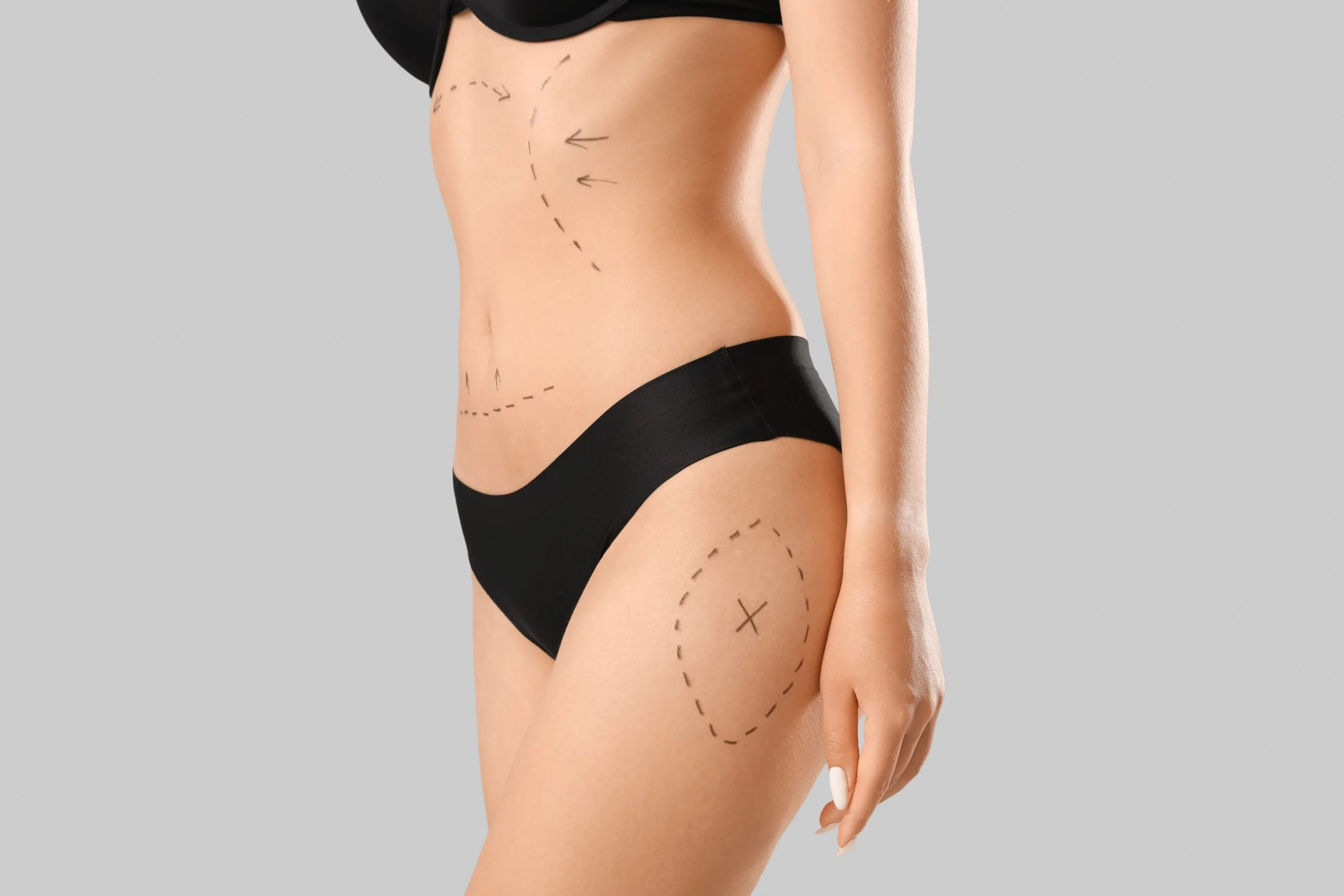 Woman's side profile with surgical markings on abdomen and hip area indicating procedure areas