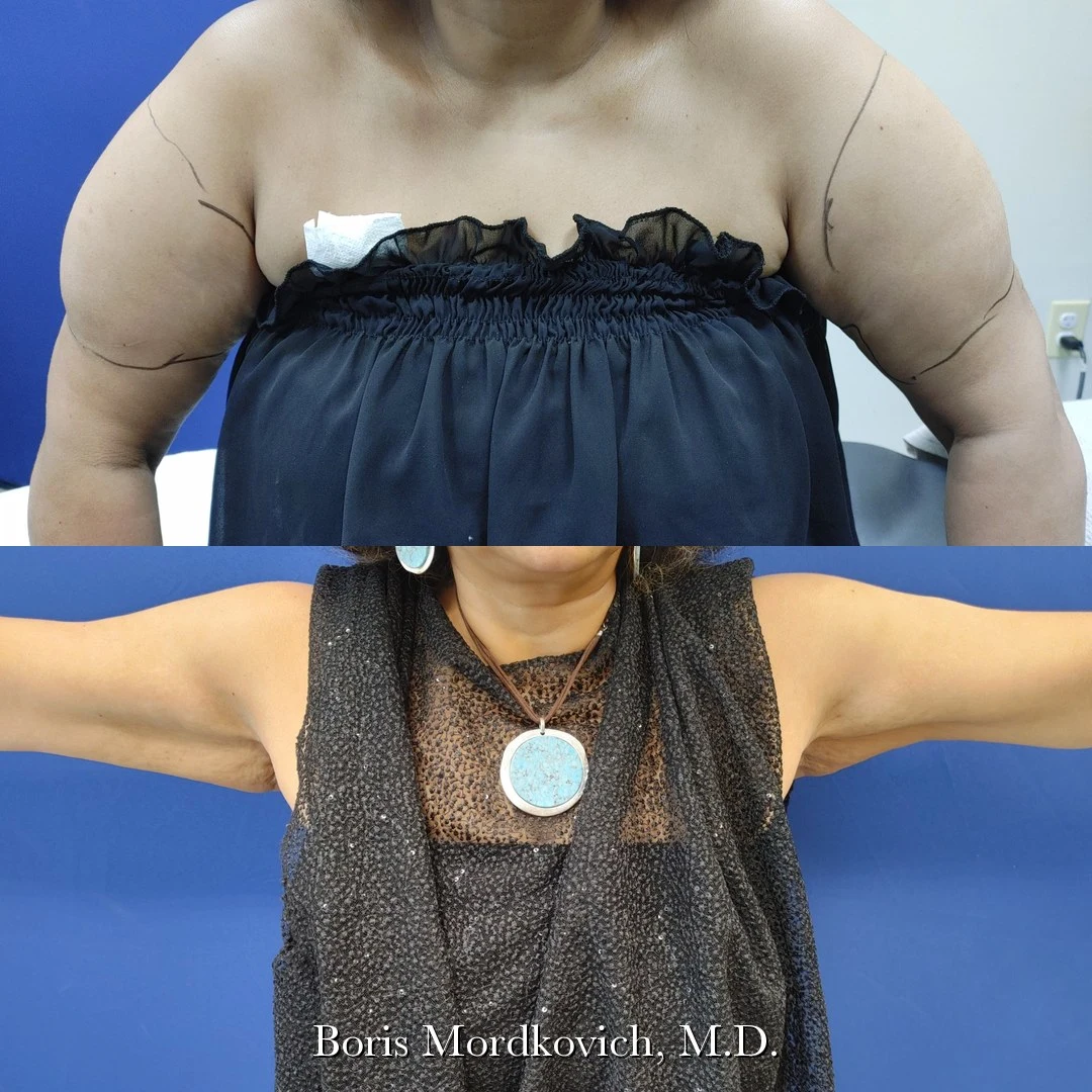 Lipedema arm treatment before and after, Boris Mordkovich M.D.