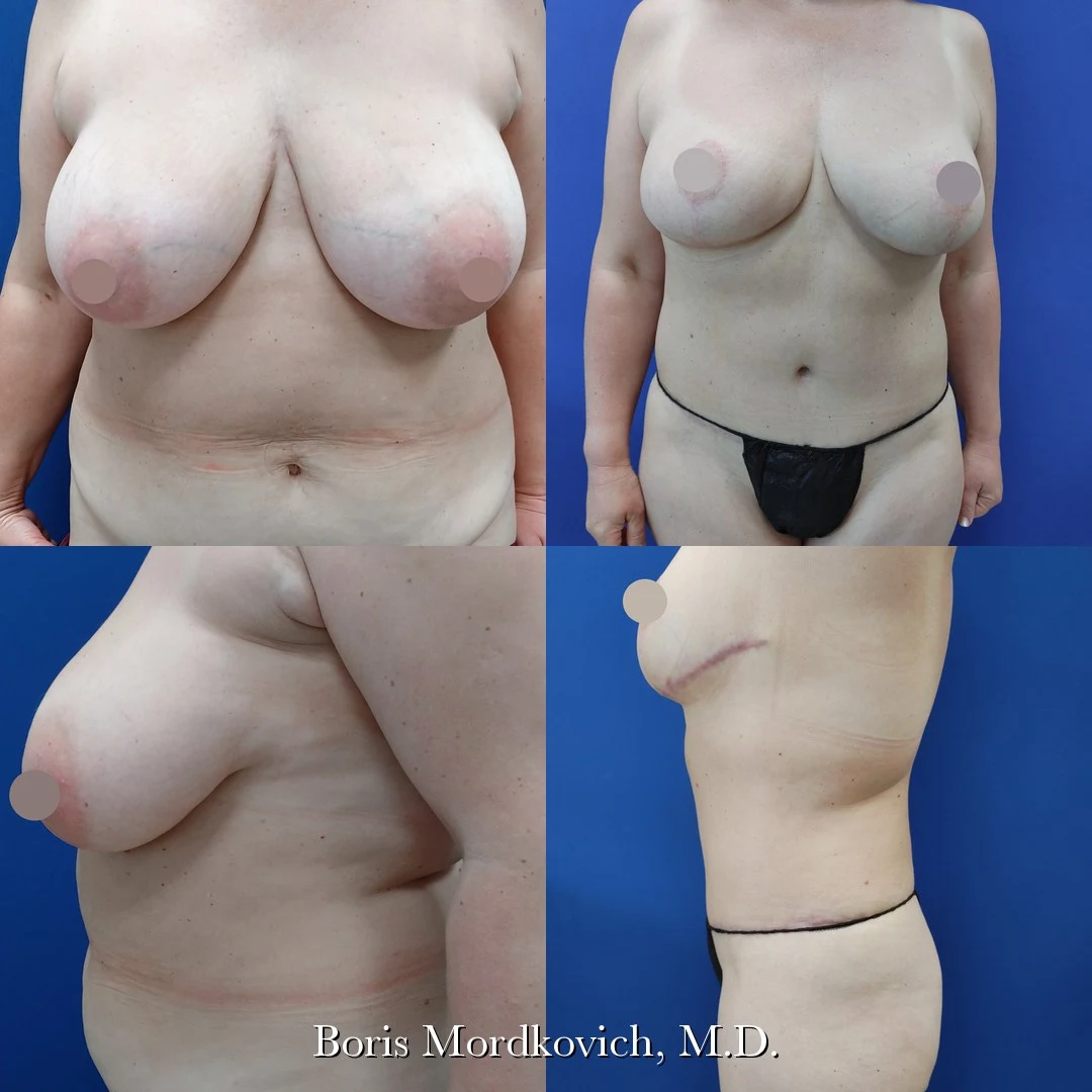 Mommy makeover before and after, front and side views, Boris Mordkovich M.D.