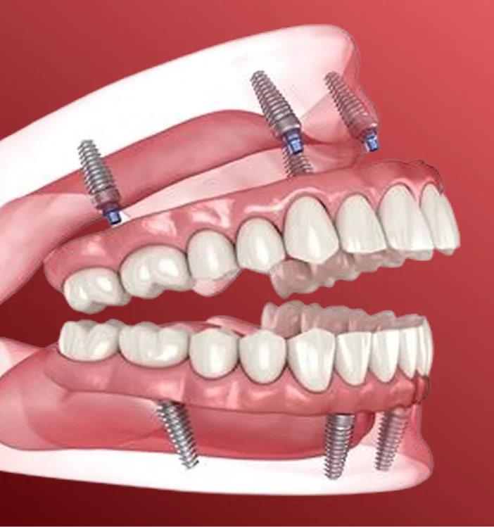 Dental implants illustration showing metal screws anchoring upper and lower rows of replacement teeth into jawbone