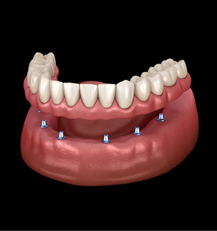 Dental implant prosthesis showing artificial teeth attached to five implant posts in the lower jawbone