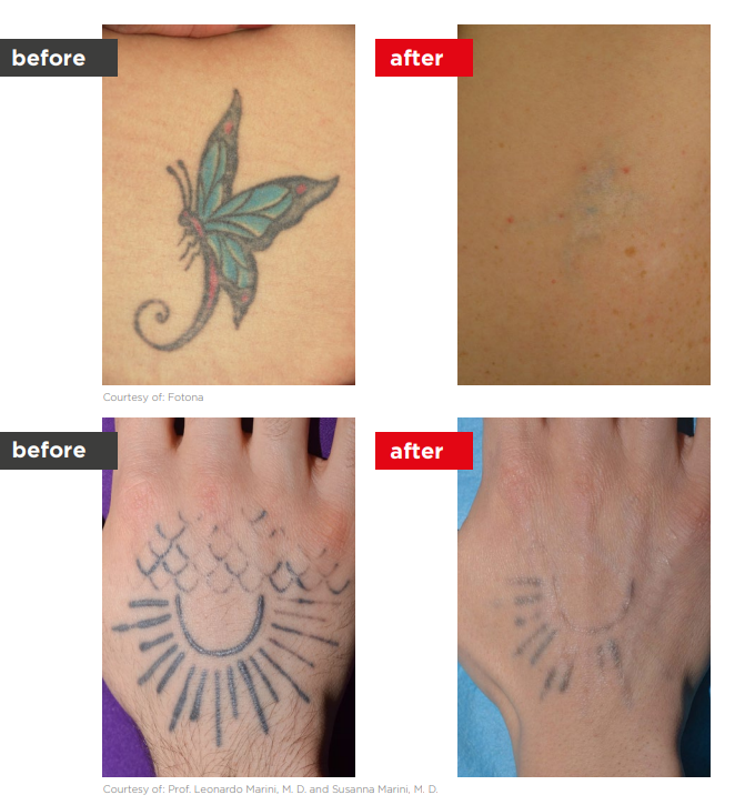 Before and after tattoo removal: teal and pink butterfly on shoulder before treatment, significantly faded skin after laser removal