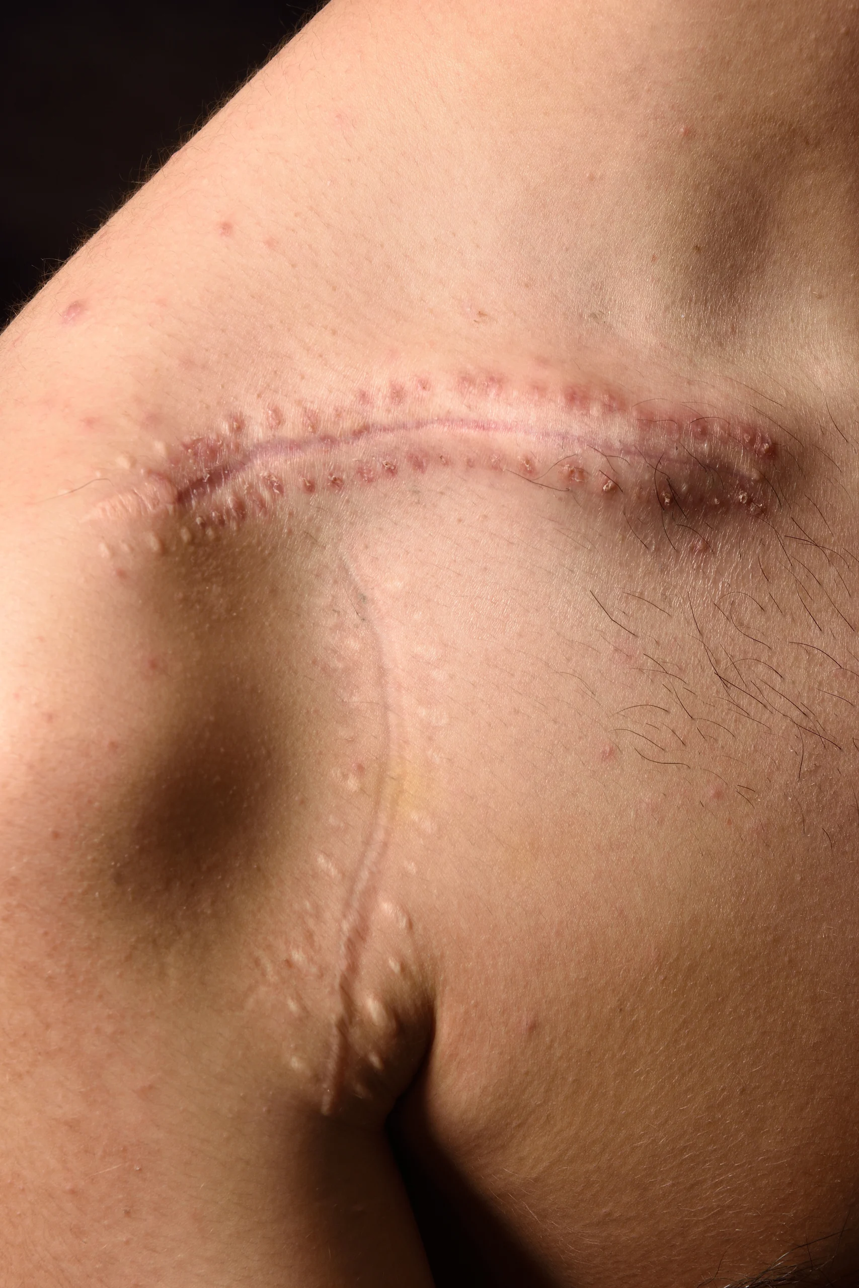Close-up of a raised scar along the clavicle area on skin