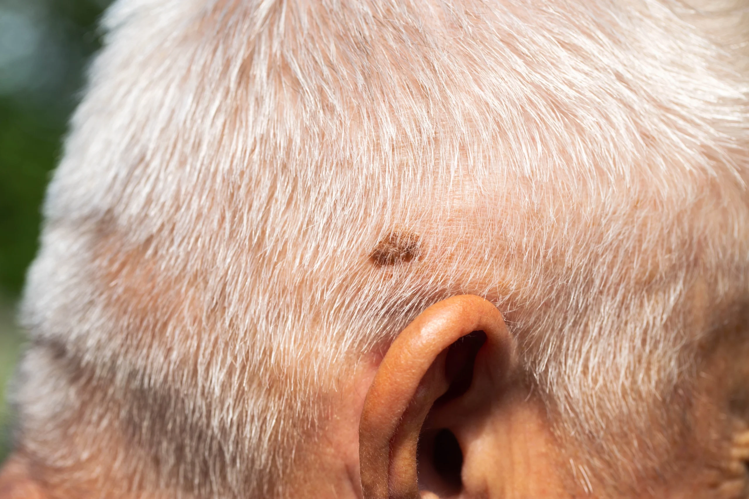 Dark brown mole on the scalp of a patient with gray hair