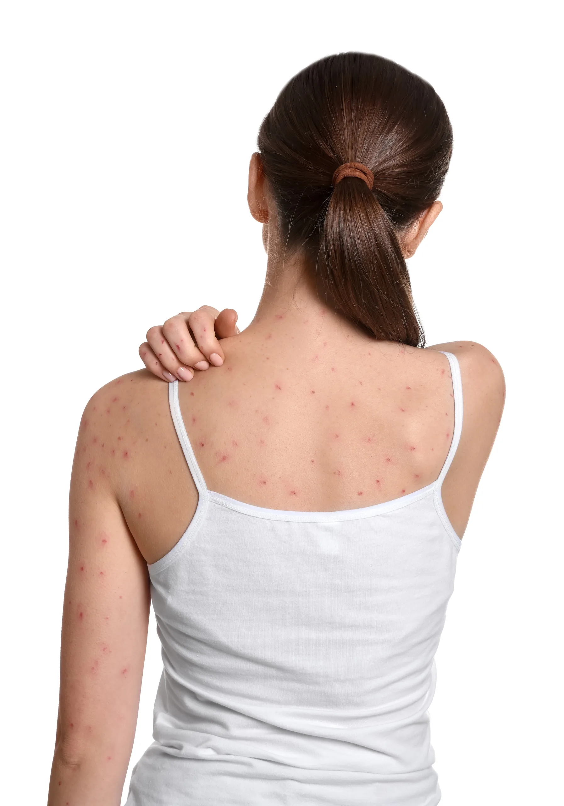 Woman from behind with acne on back and shoulders, wearing white tank top