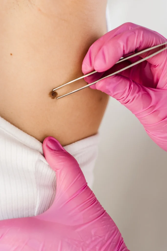 Gloved hands with tweezers examining a mole on a patient's skin