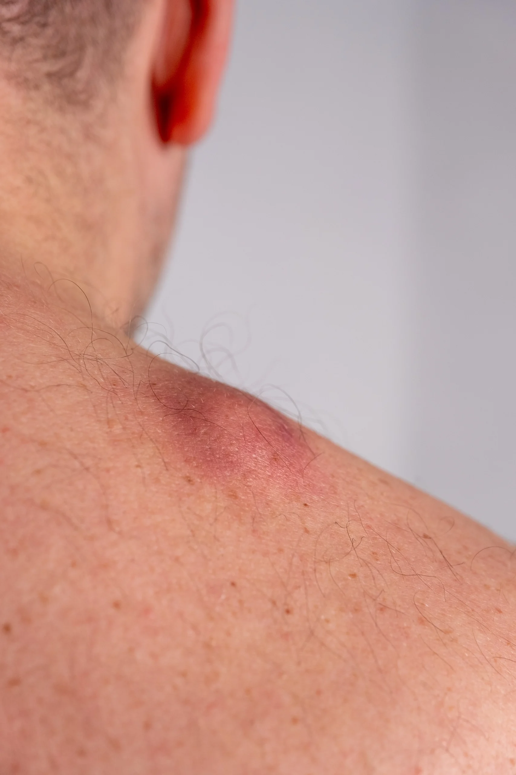 Close-up of skin showing redness and inflammation on shoulder and neck area