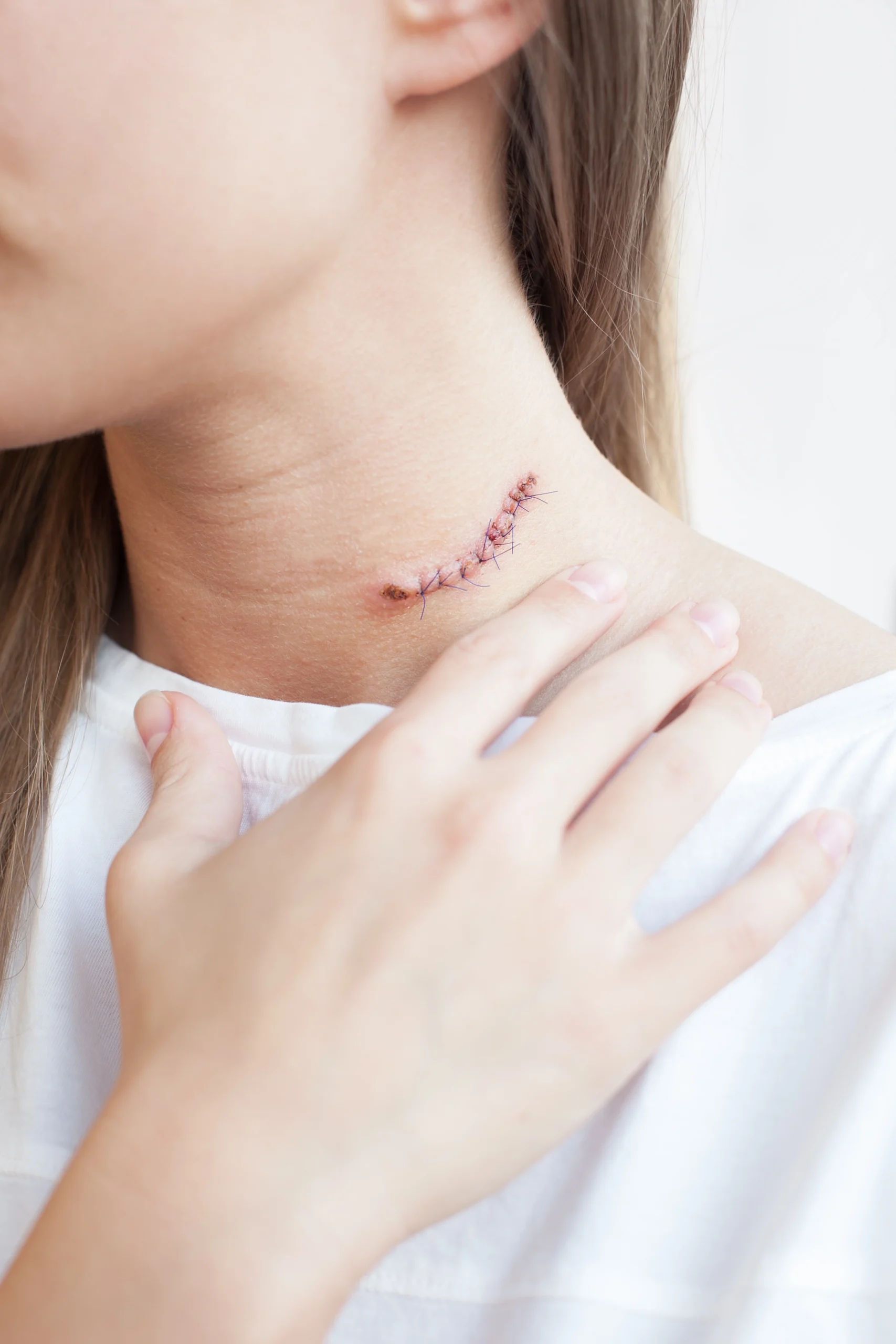 Close-up of a surgical scar with sutures on a person's neck