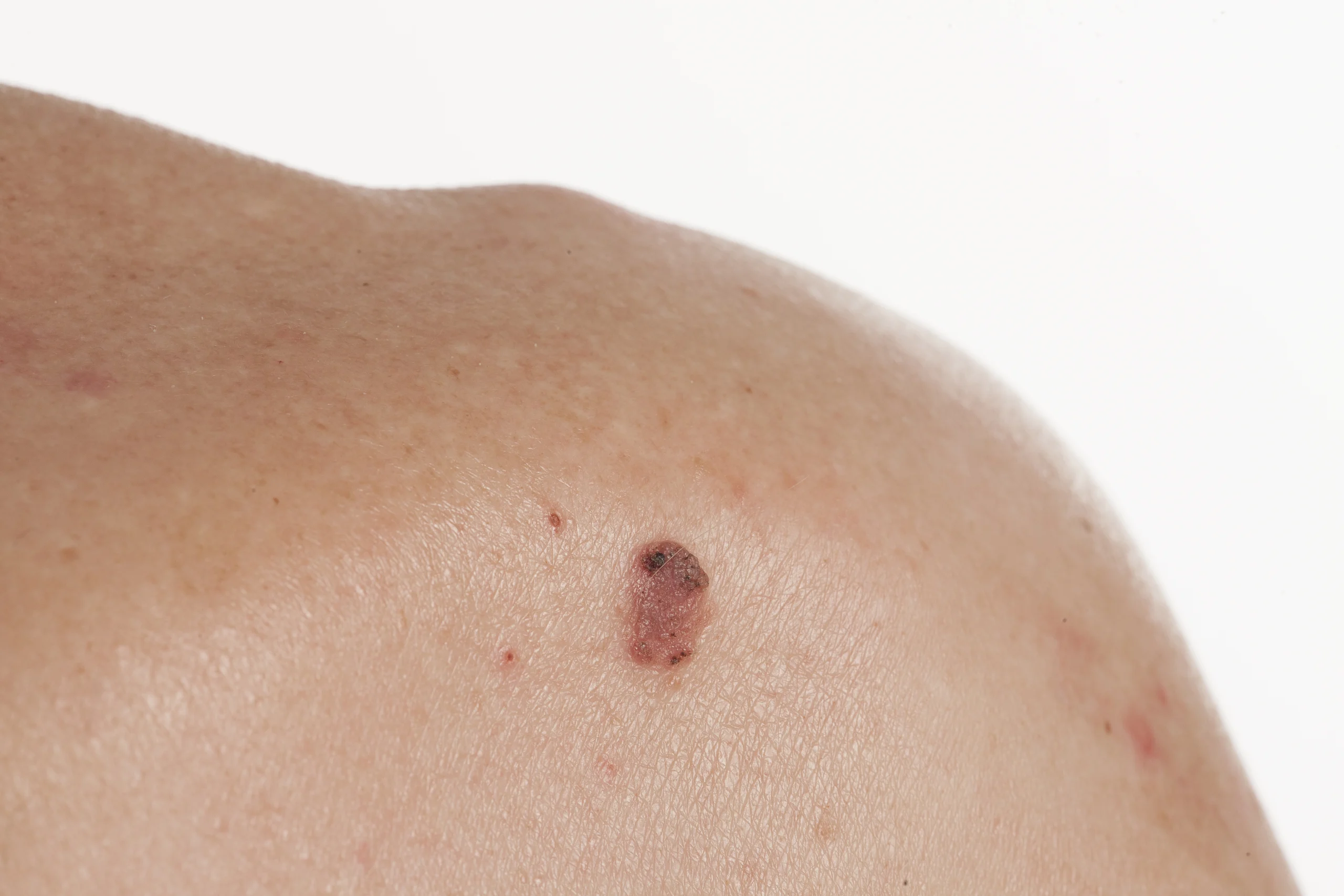 Close-up of squamous cell carcinoma lesion on skin
