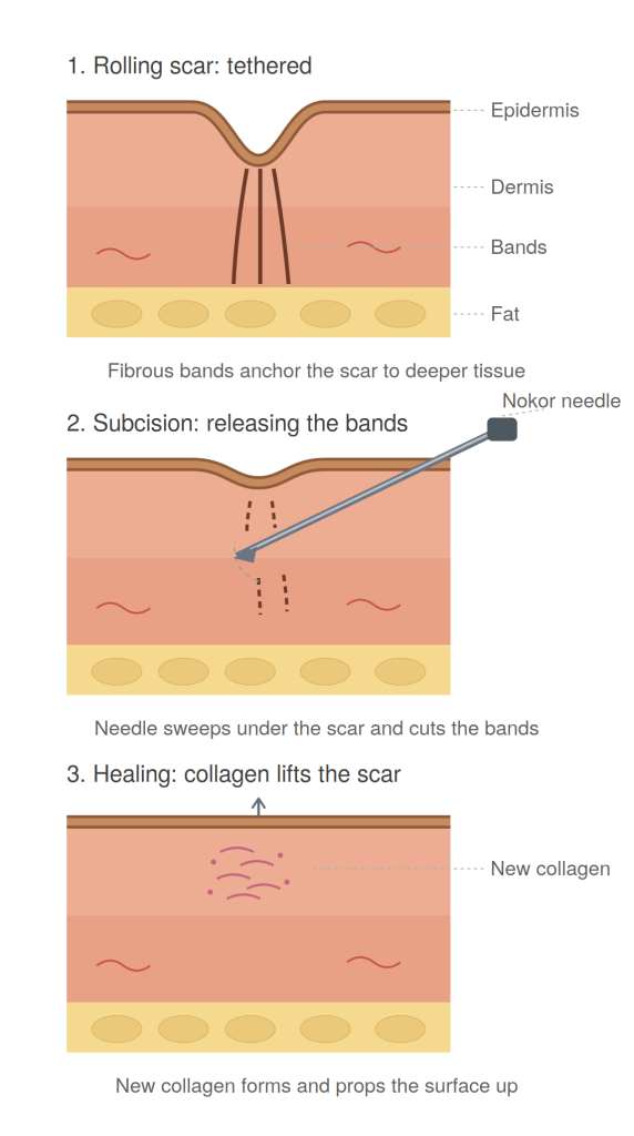 Diagram showing subcision procedure: rolling scar with tethered fibrous bands, Nokor needle releasing bands, and new collagen lifting the scar during healing