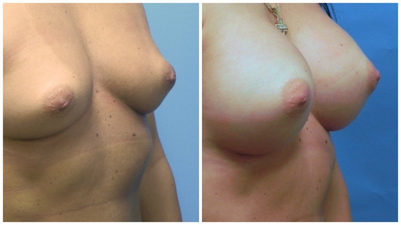 breast23