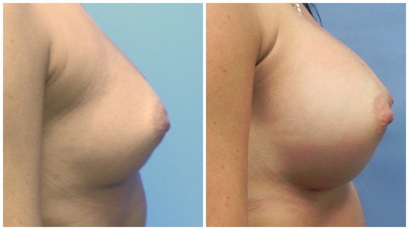 breast24
